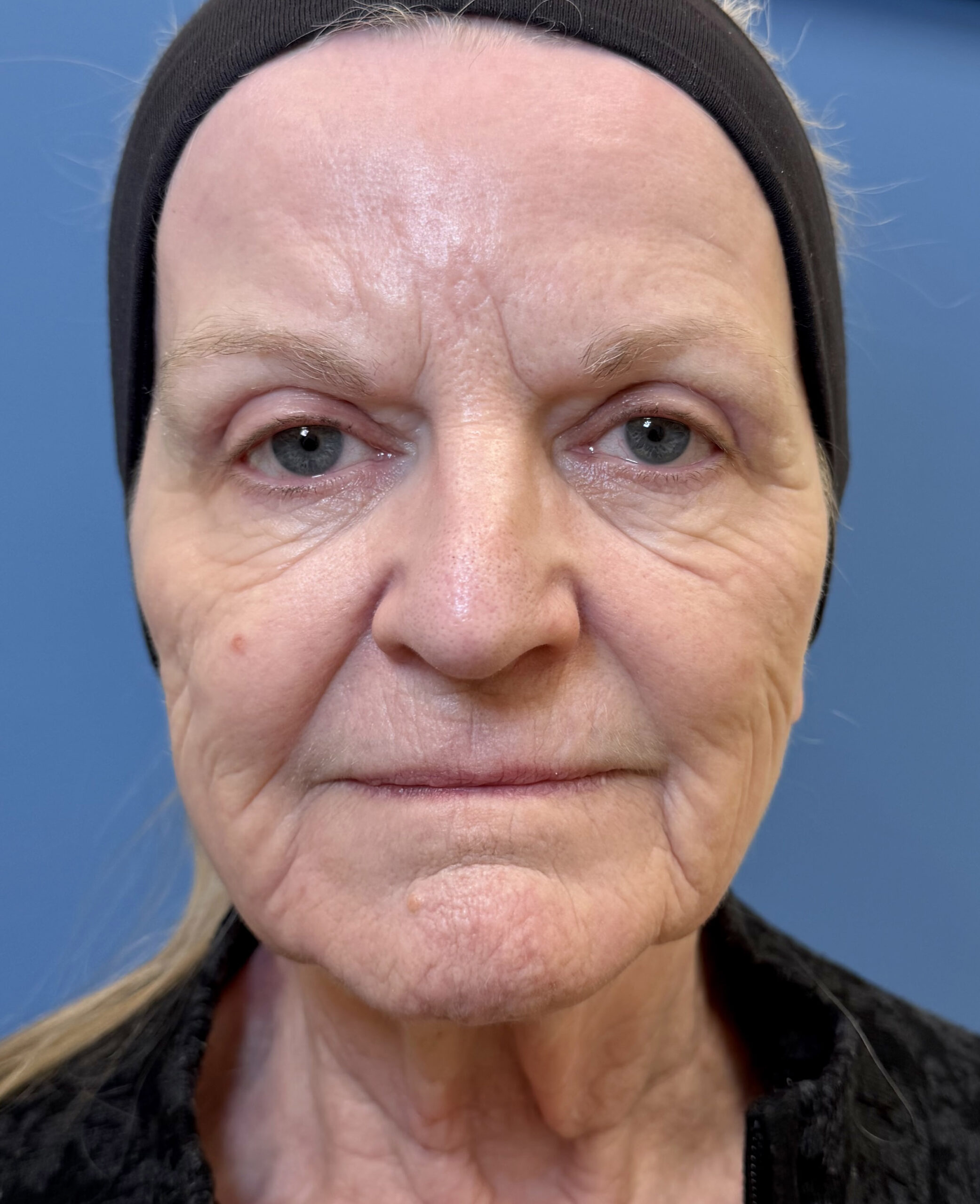 Blepharoplasty – Patient 15 After