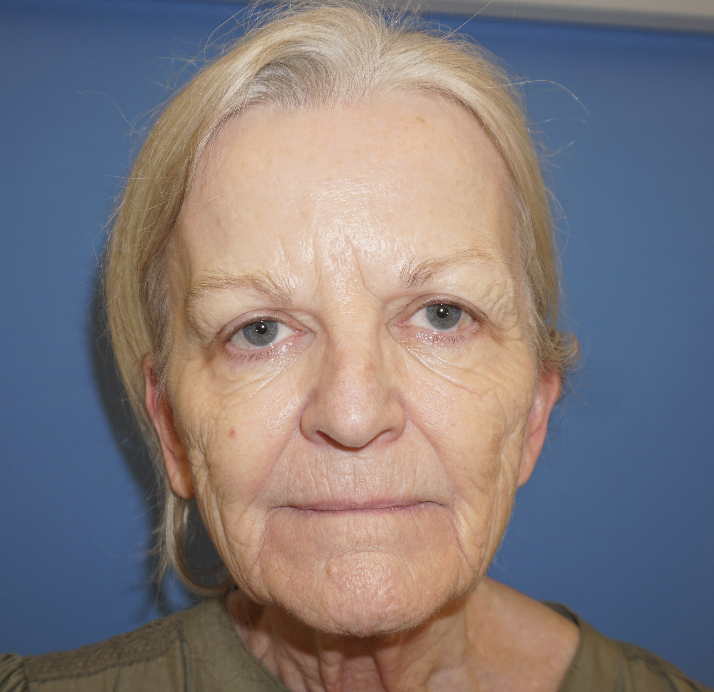 Blepharoplasty – Patient 15 Before