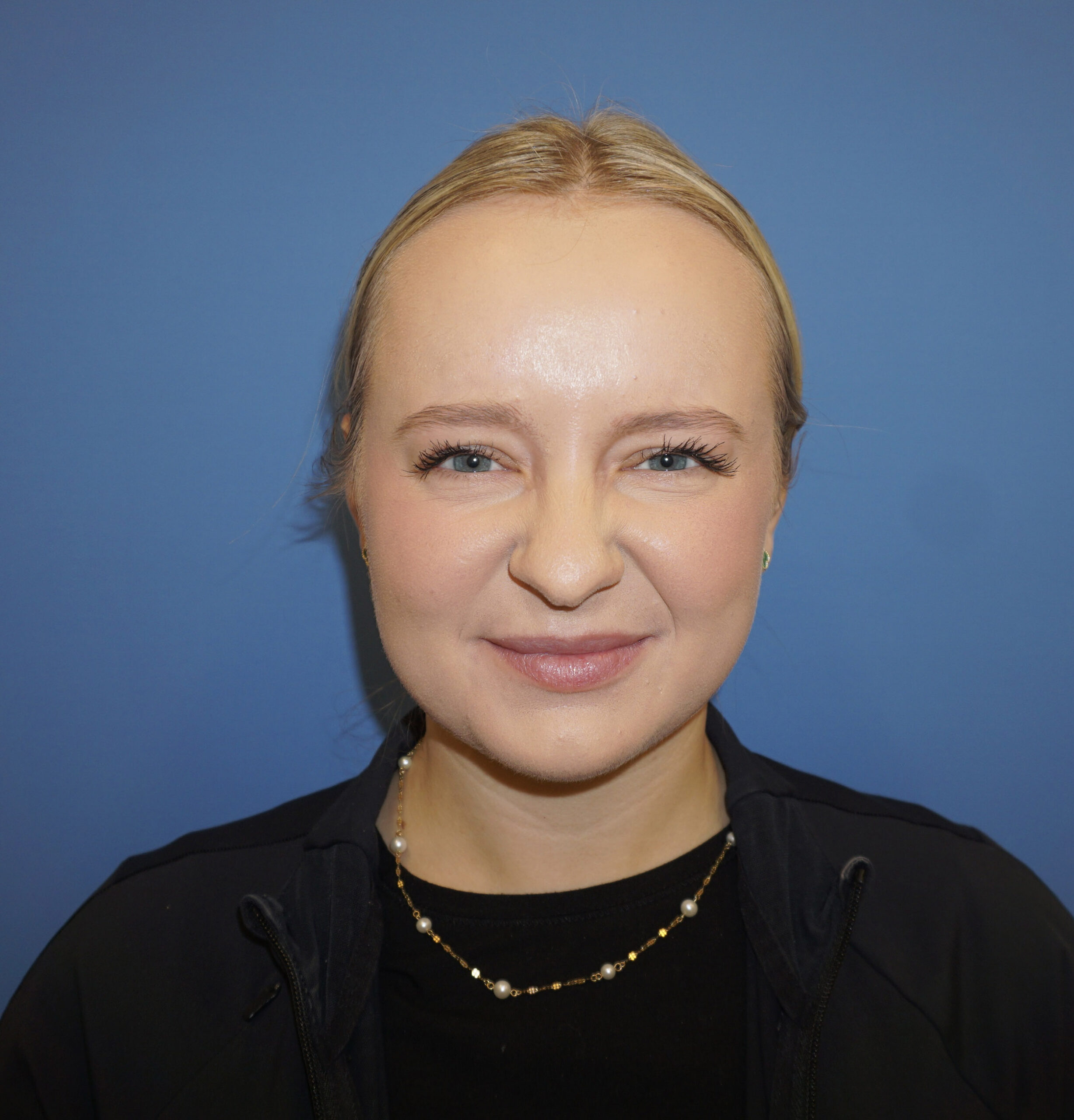 Botox – Patient 16 After