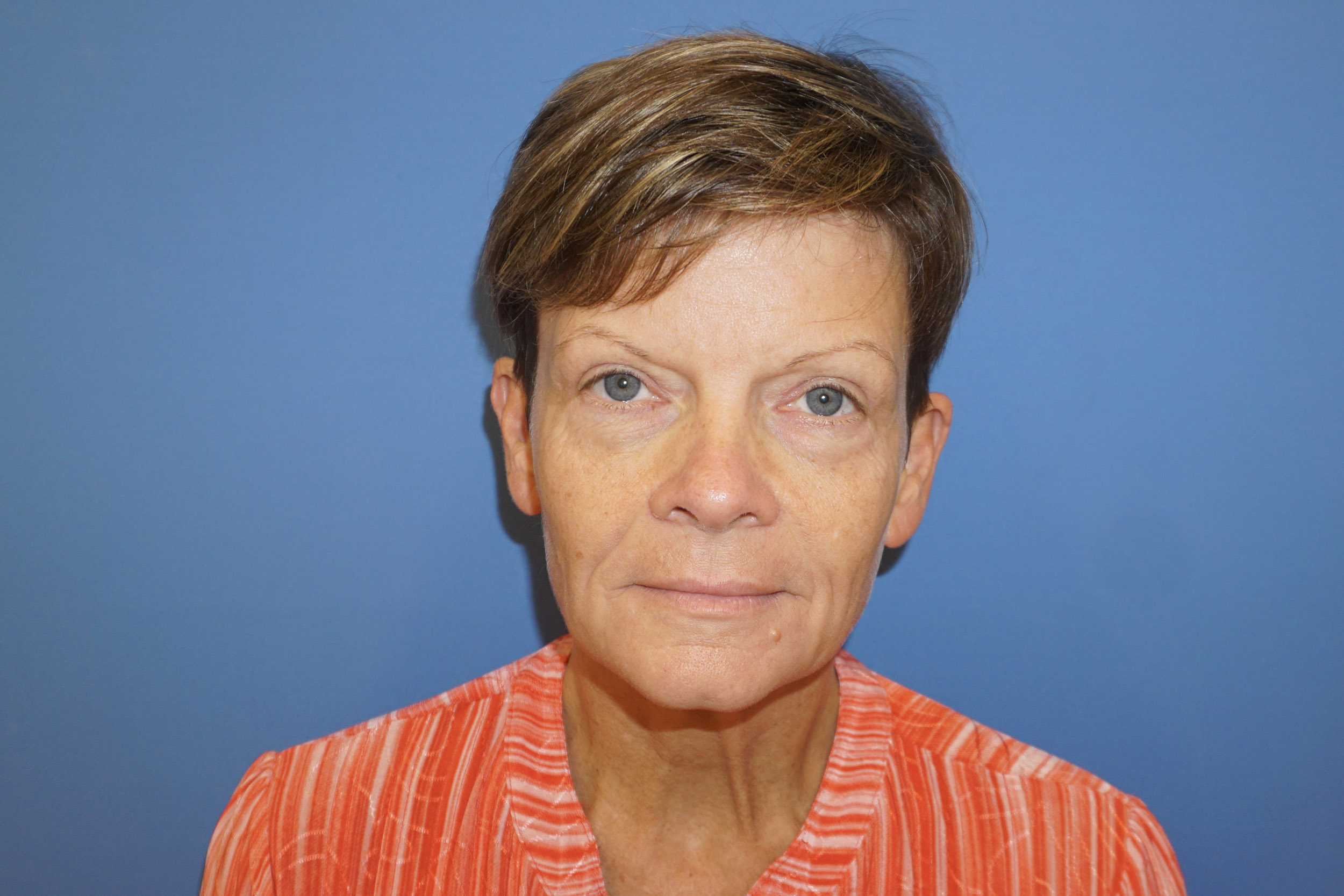 Blepharoplasty – Patient 16 After