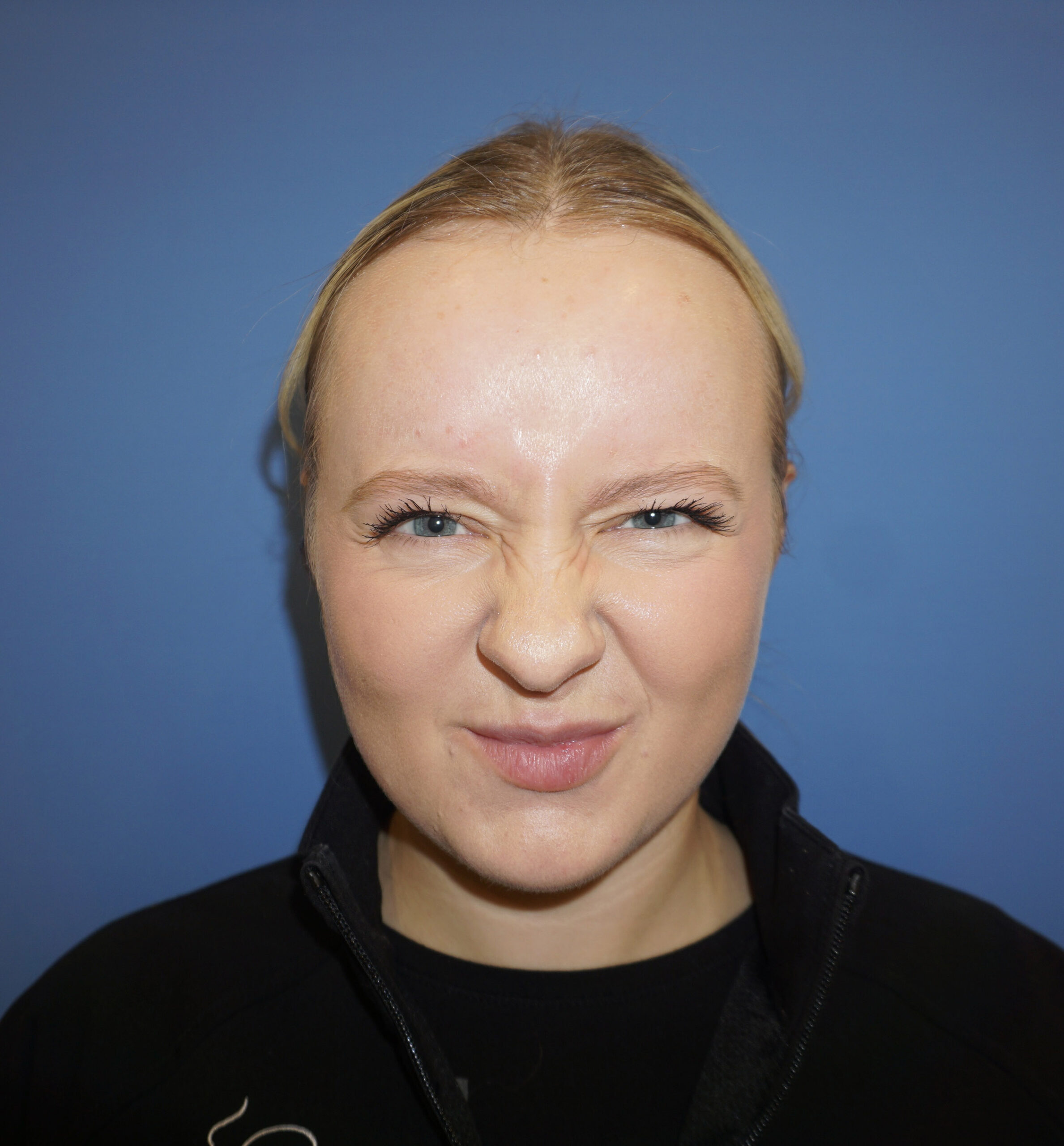 Botox – Patient 16 Before