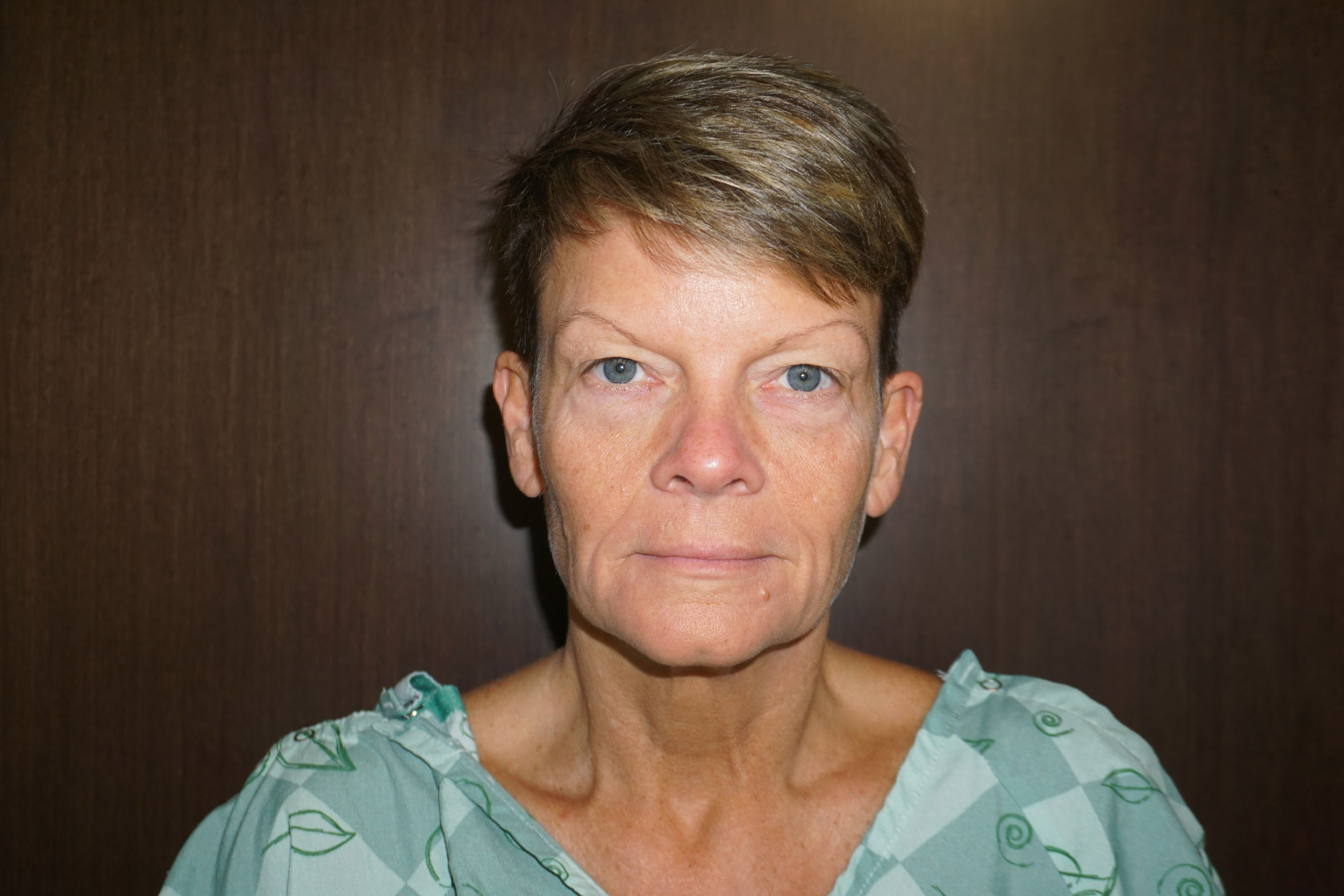 Blepharoplasty – Patient 16 Before