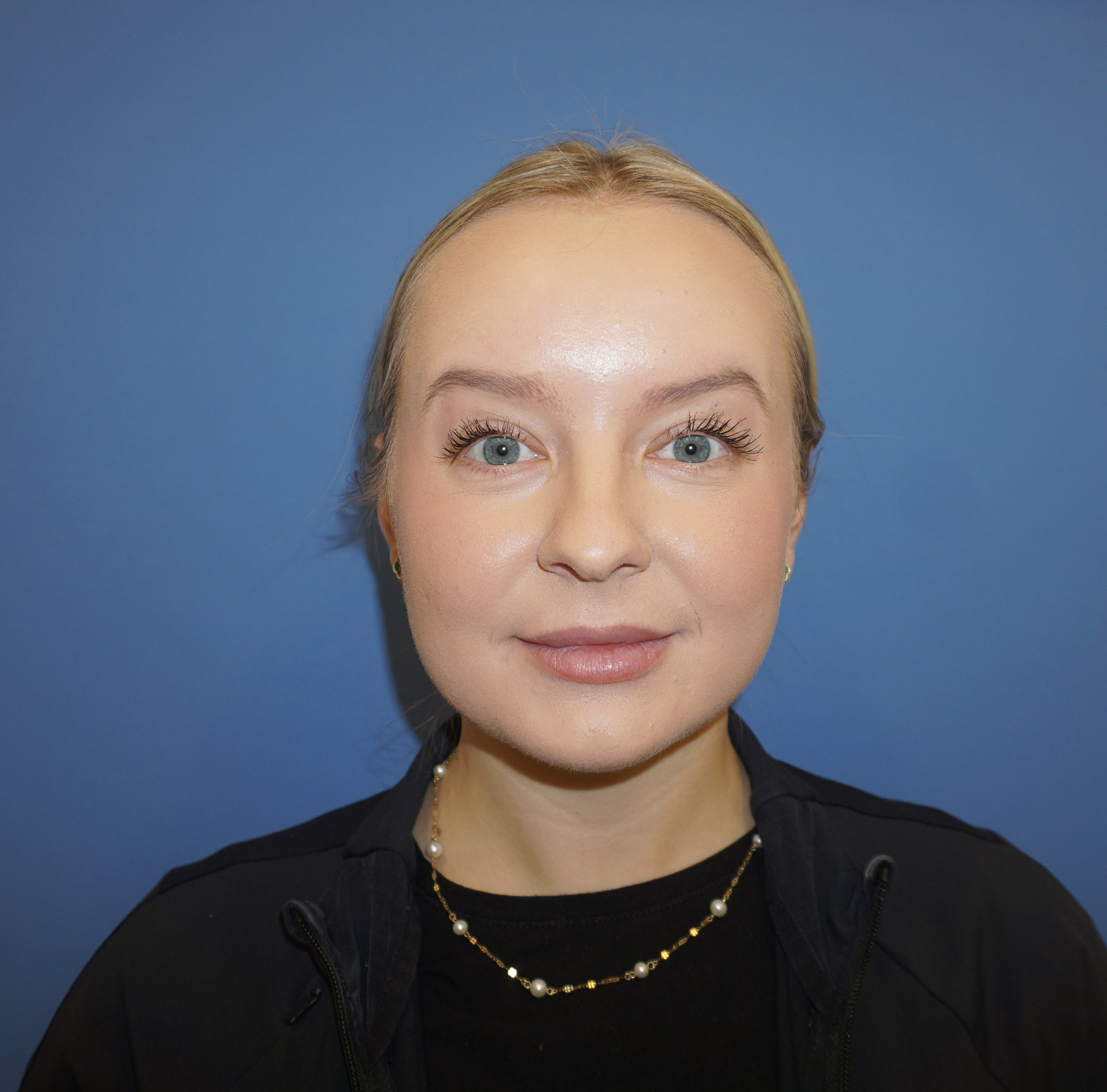 Botox – Patient 17 After