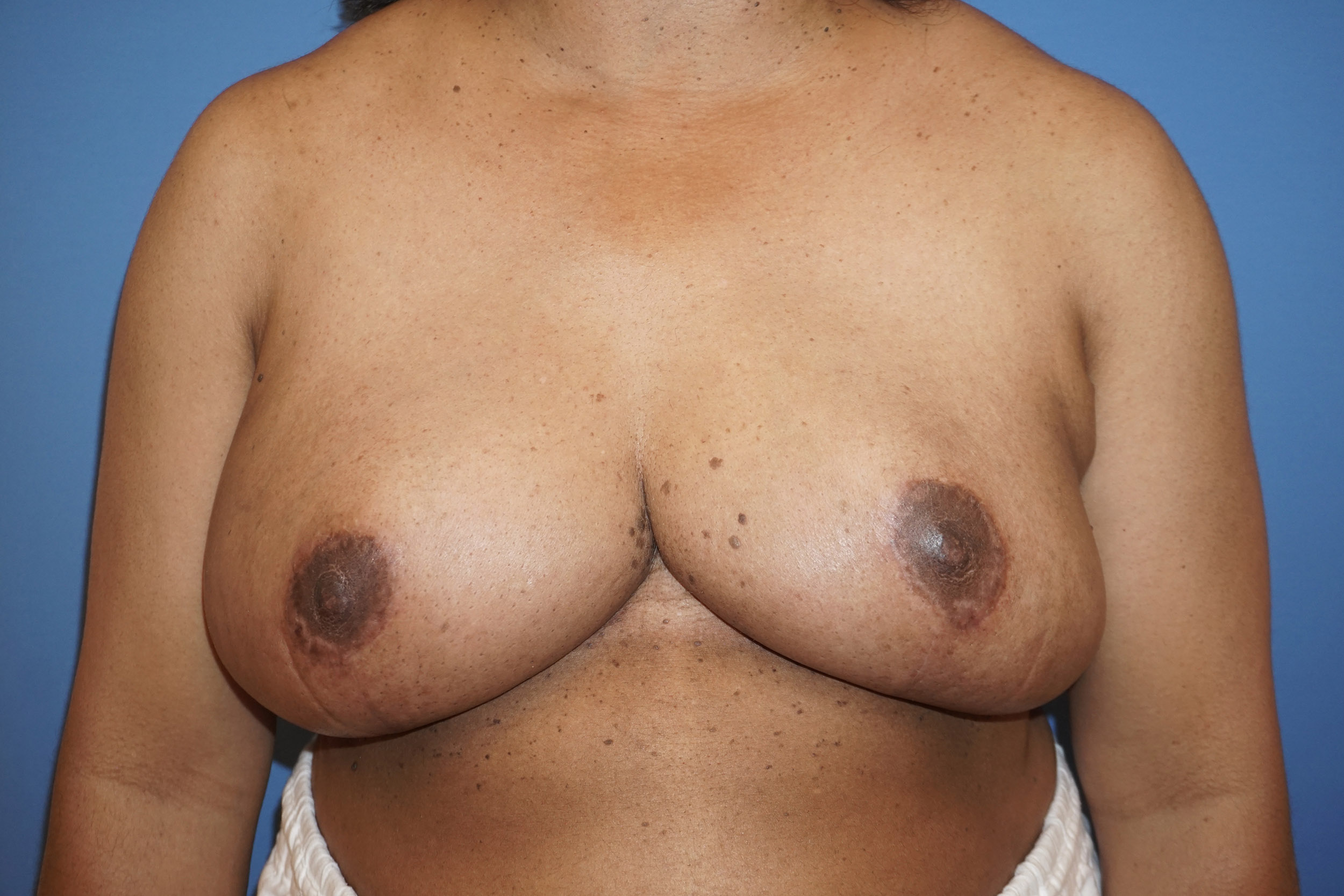 Breast Lift – Patient 17 After