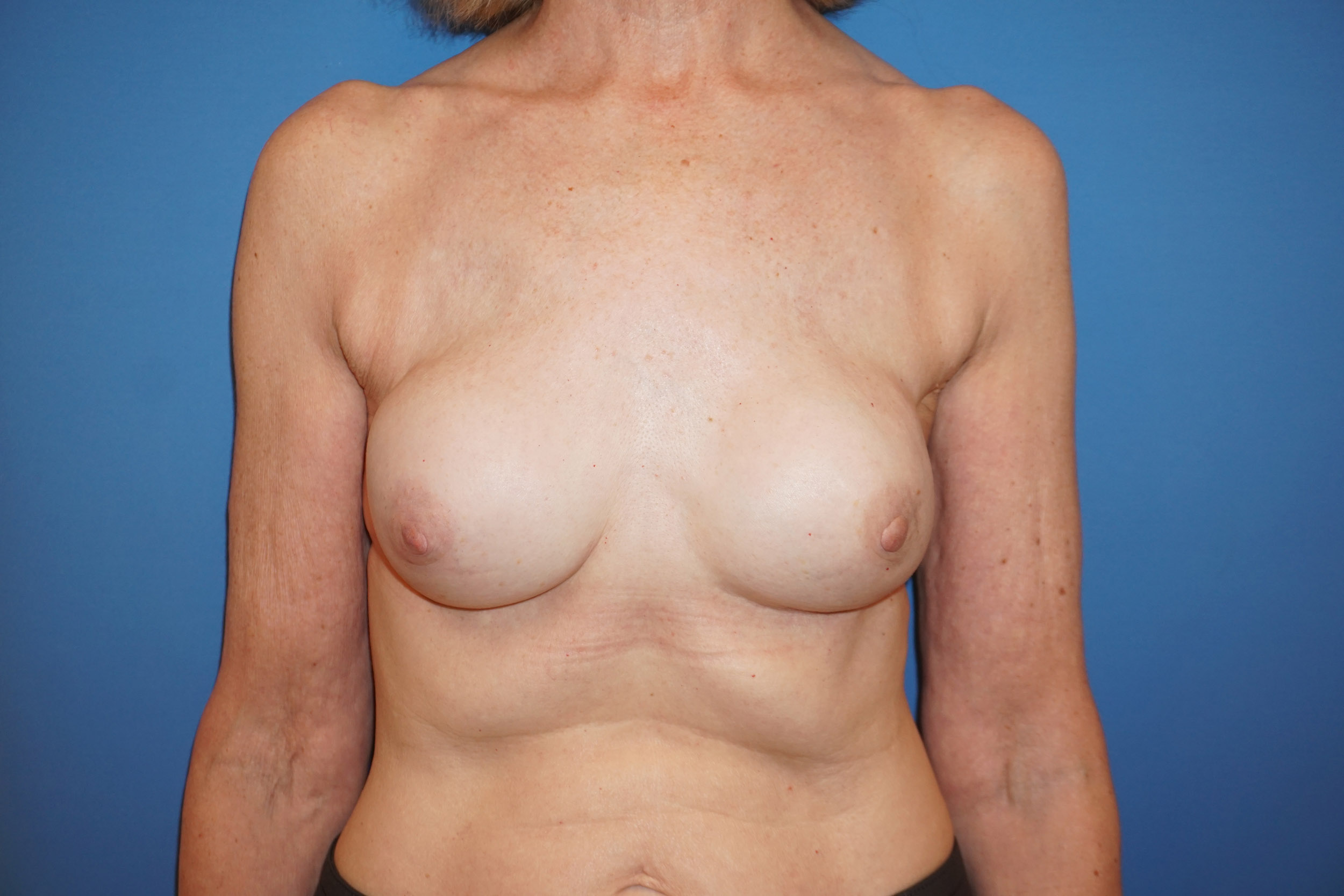 Breast Reconstruction for Cancer – Patient 17 After