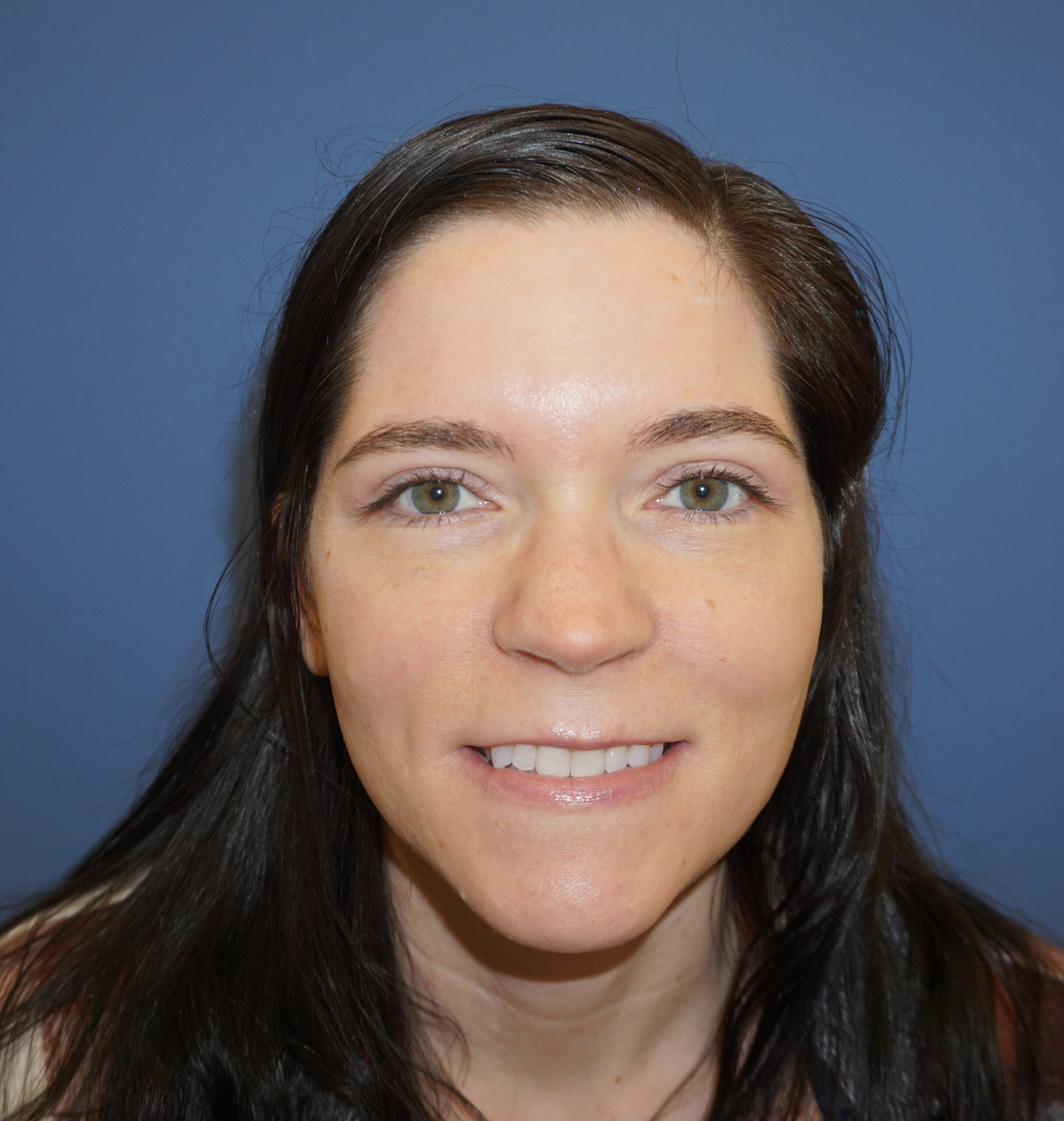 Blepharoplasty – Patient 17 After