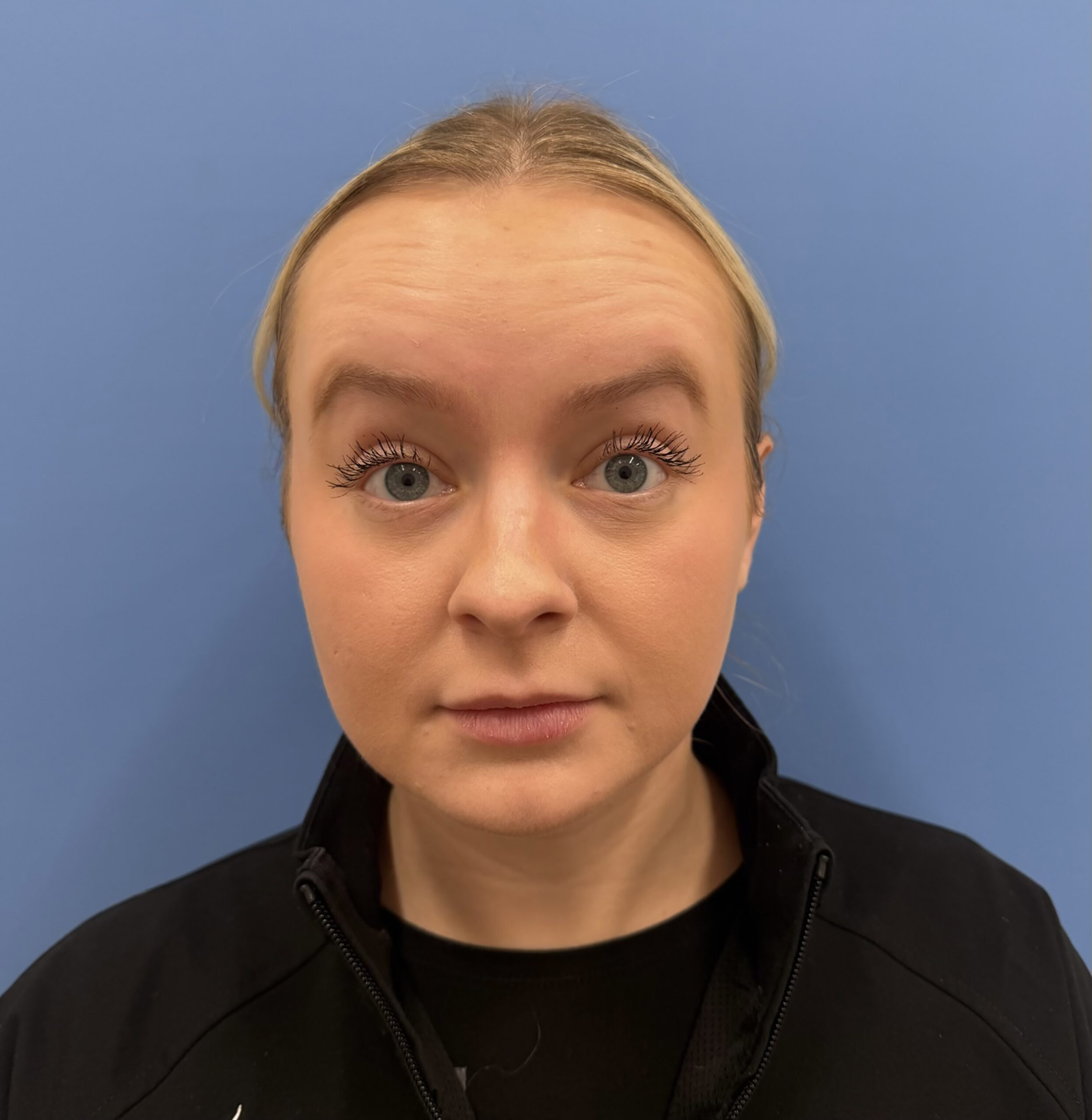 Botox – Patient 17 Before