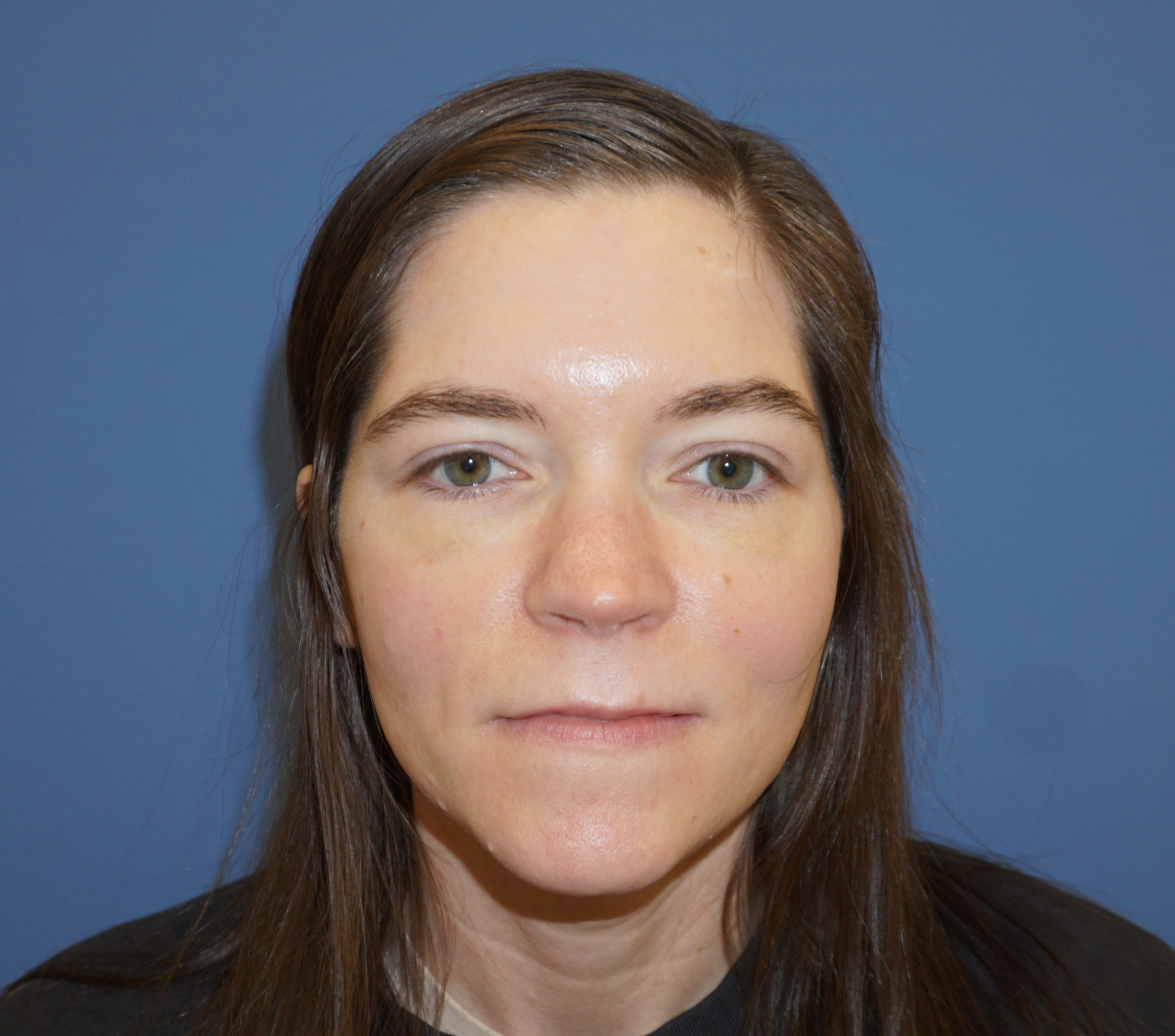 Blepharoplasty – Patient 17 Before