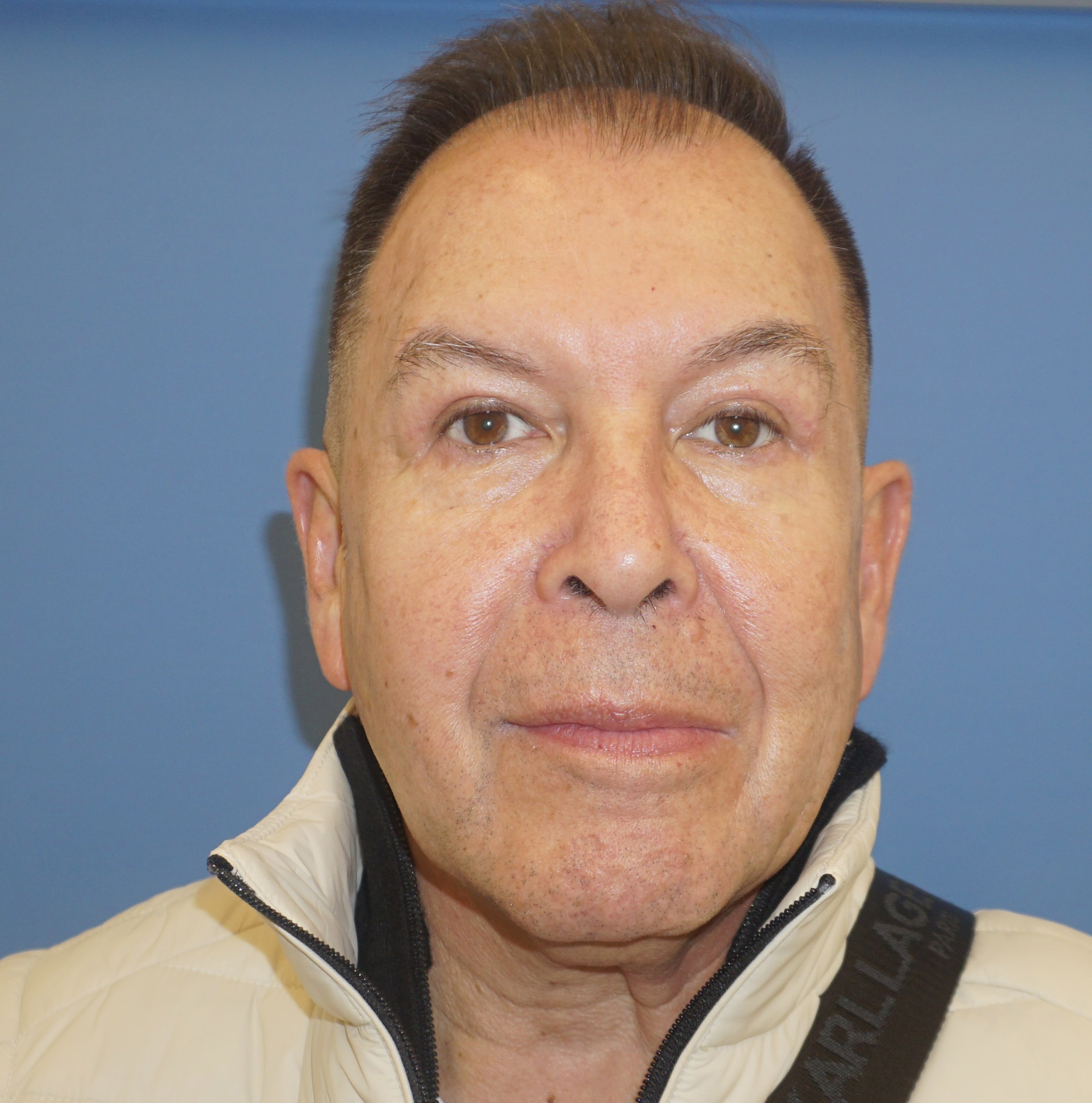 Blepharoplasty – Patient 18 After