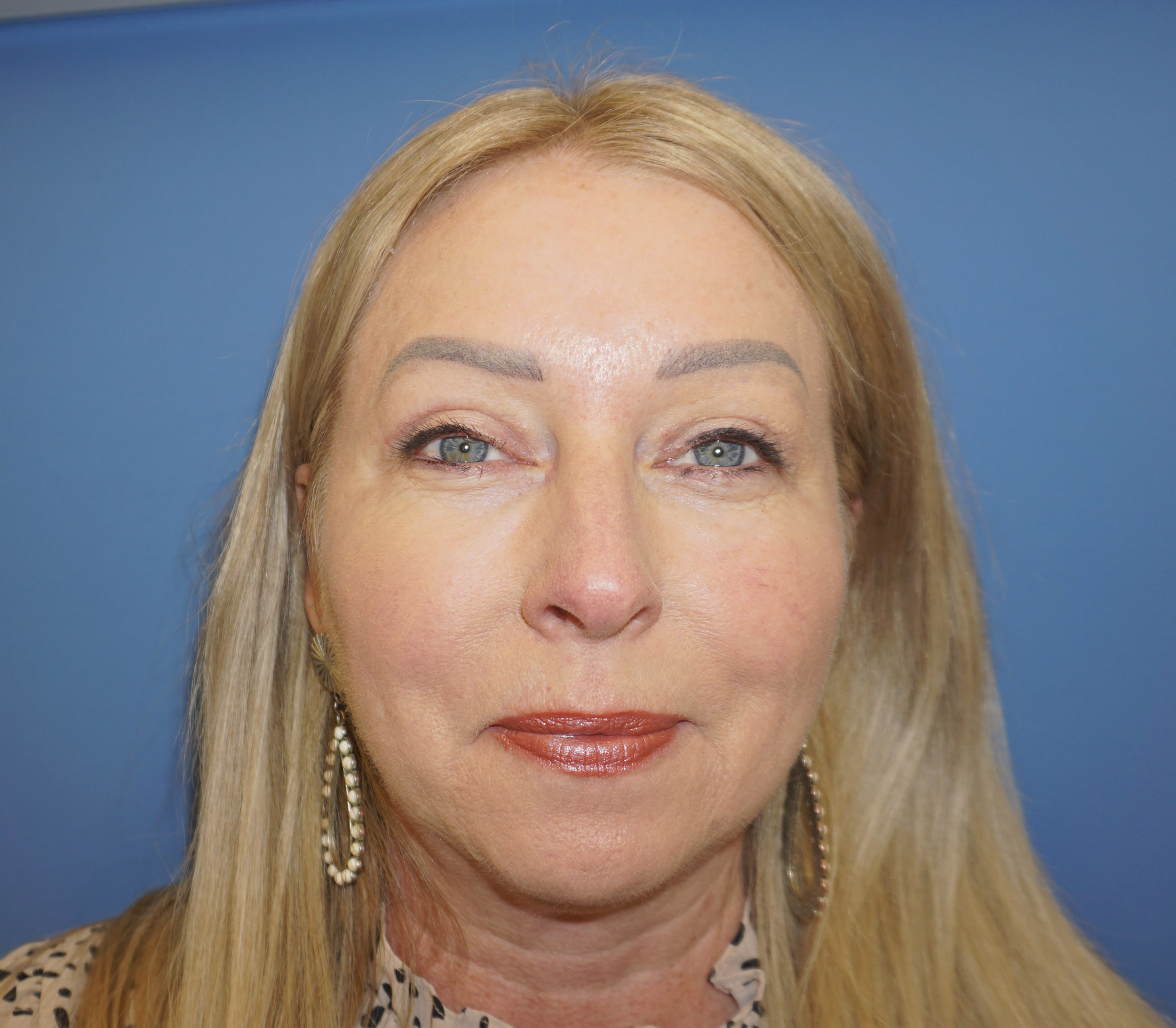 Blepharoplasty – Patient 19 After