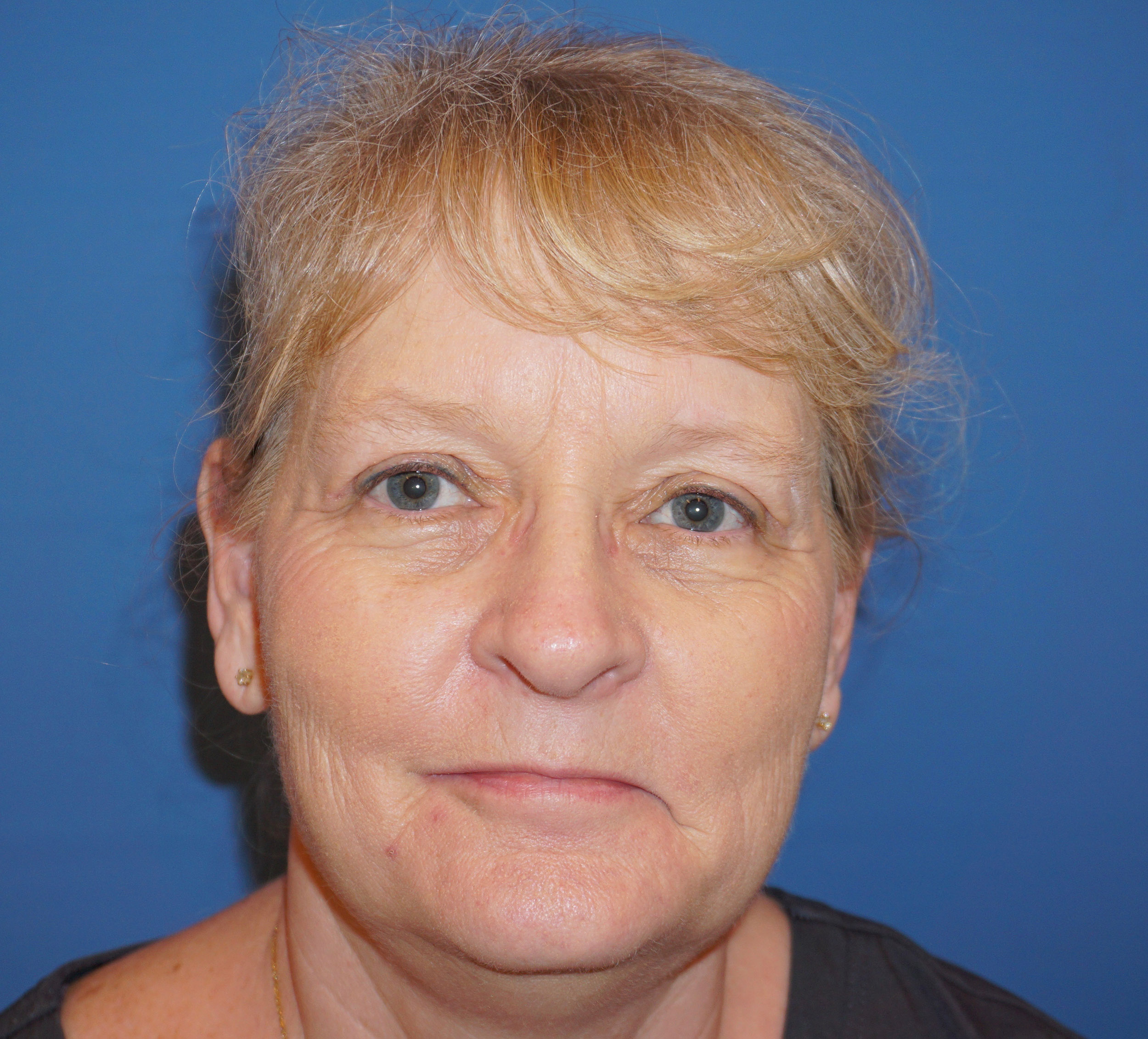 Blepharoplasty – Patient 2 After