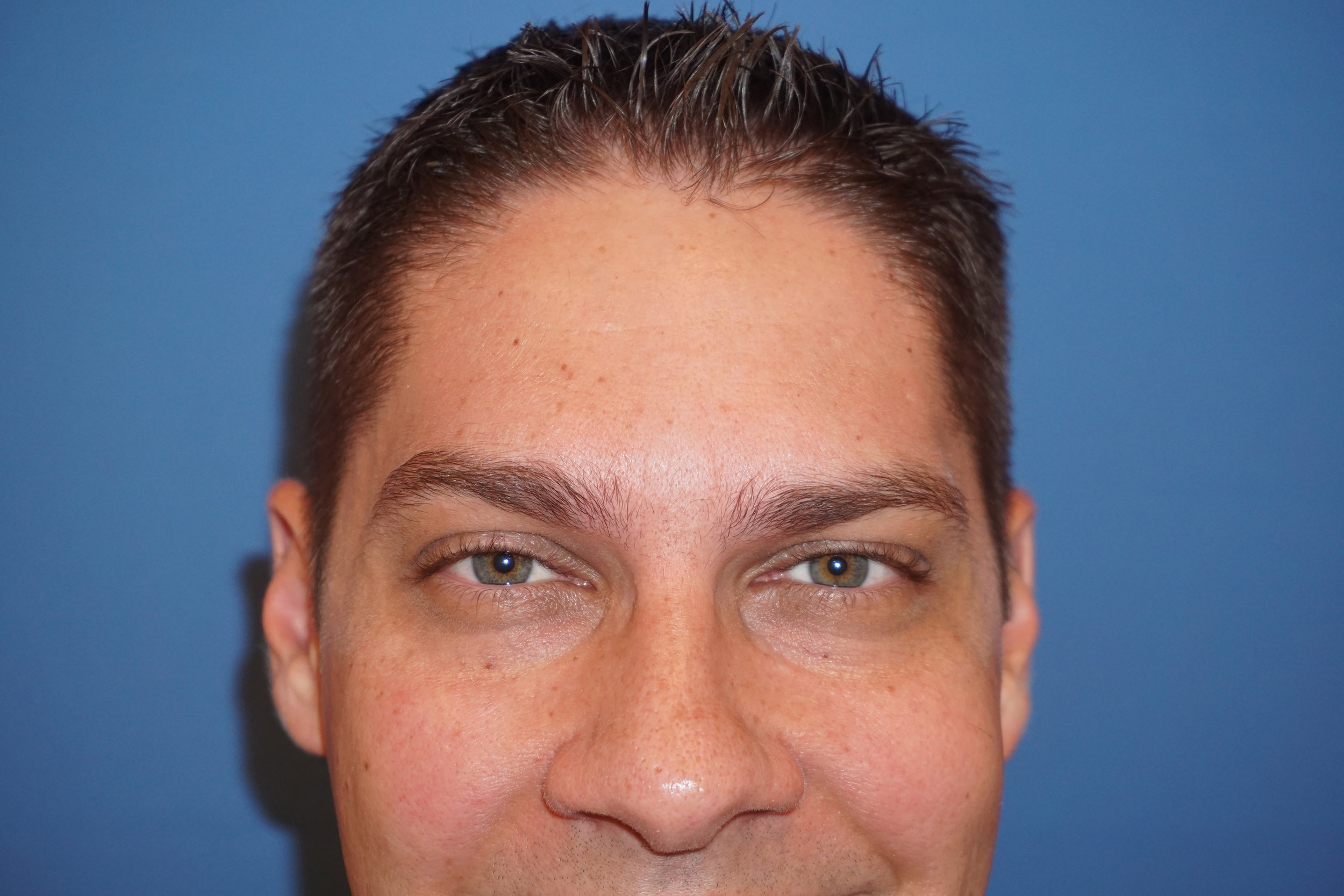 Botox – Patient 2 After