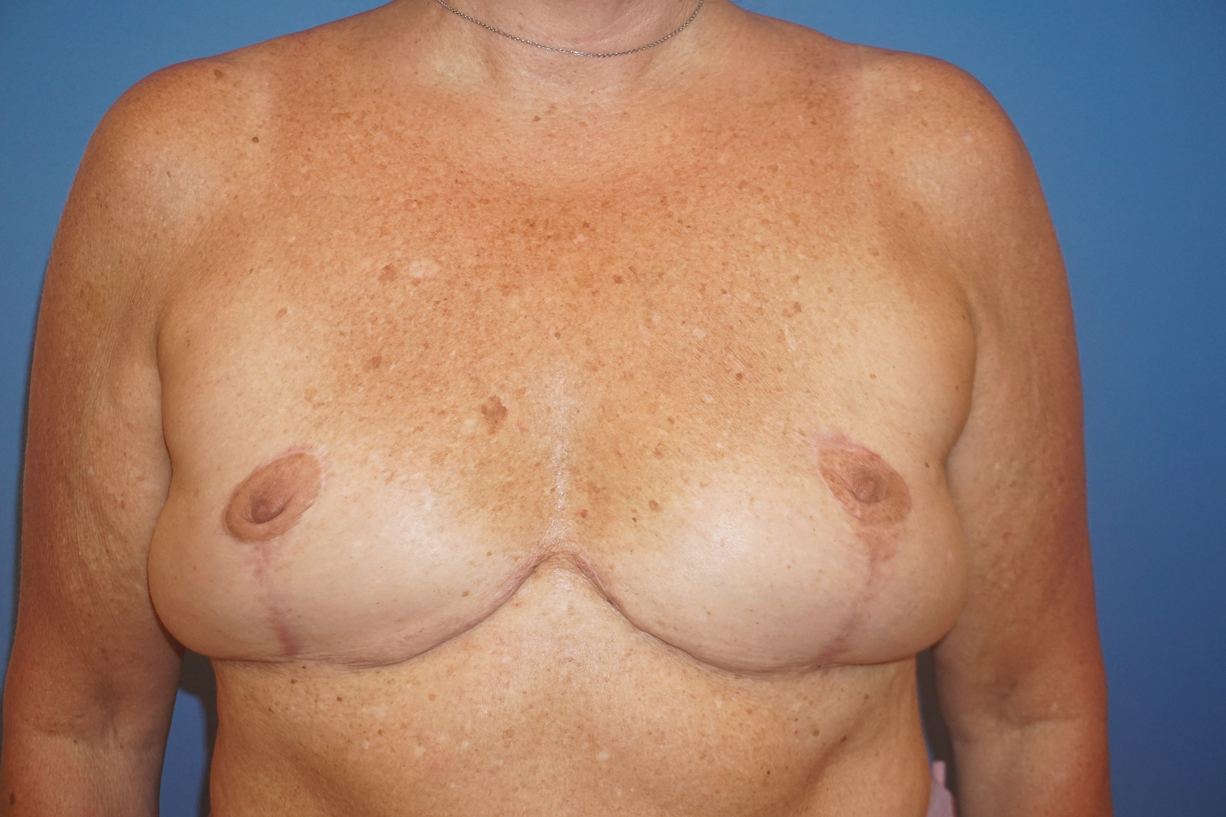 Breast Implant Removal – Patient 2 After