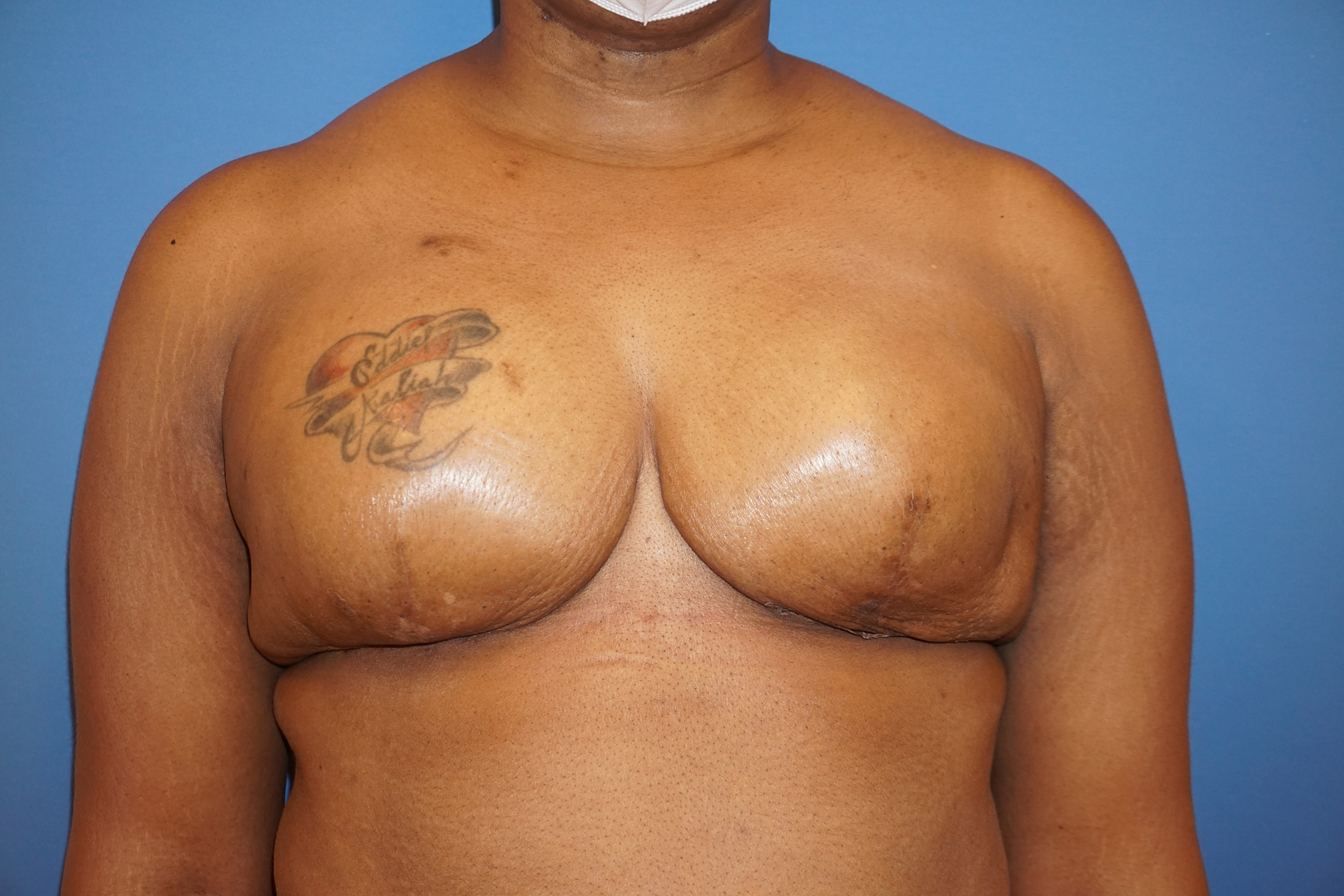 Breast Reconstruction for Cancer – Patient 2 After