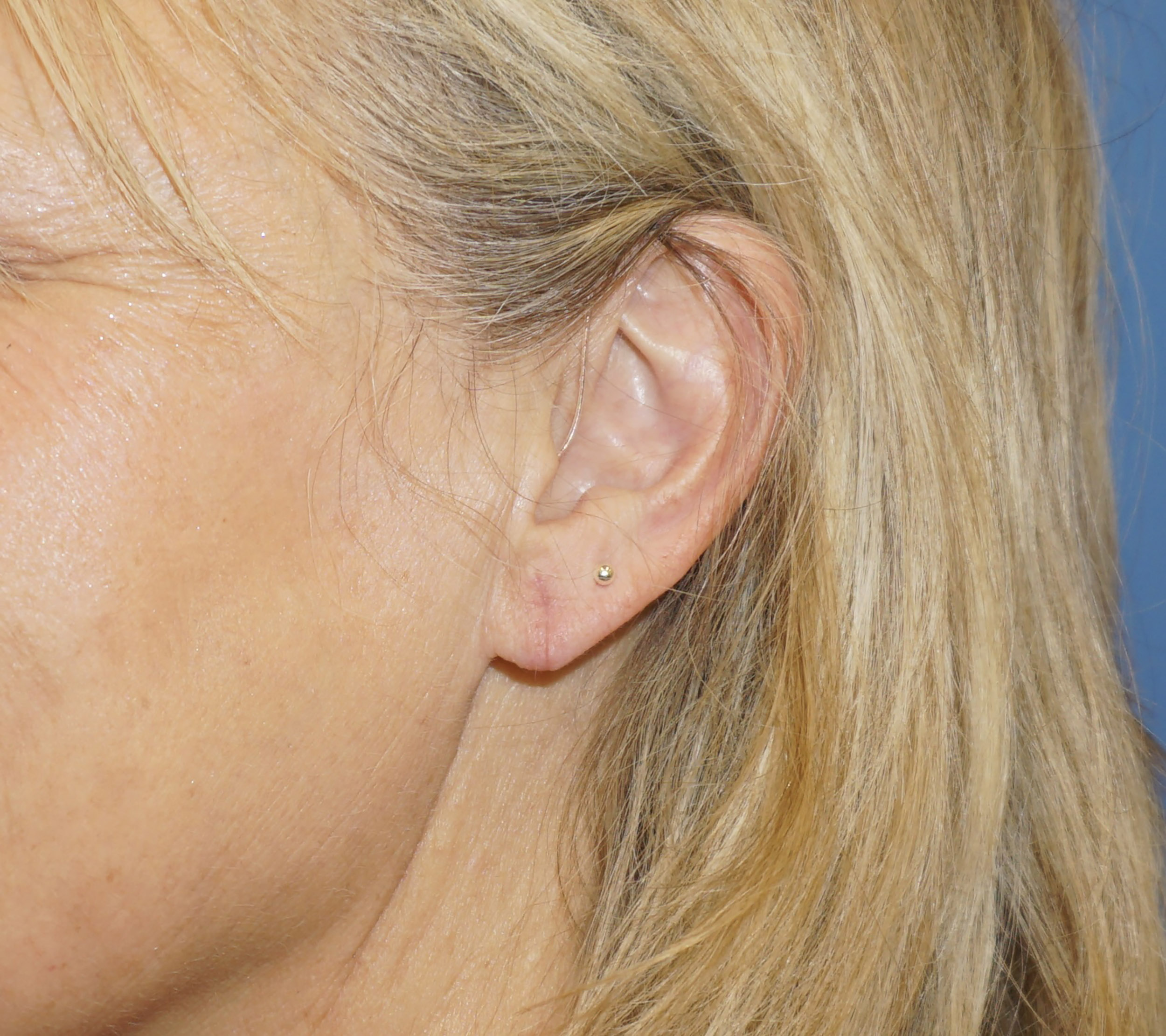 Ear Surgery – Patient 2 After