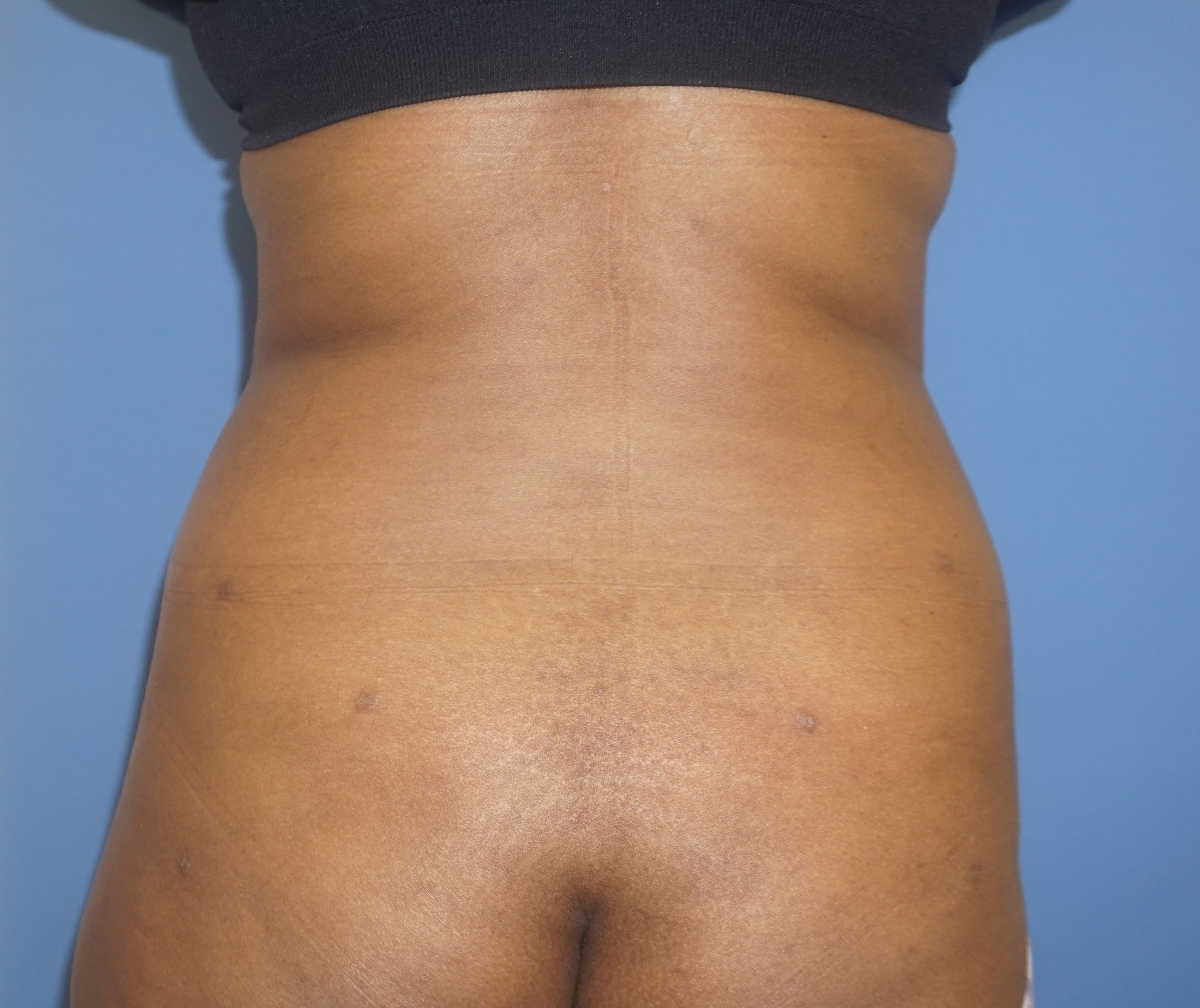 Liposuction – Patient 2 After