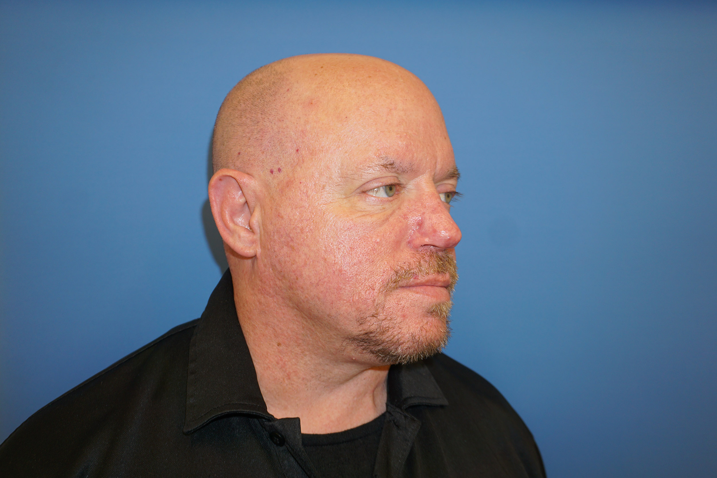 Nose Reshaping Patient 2 After