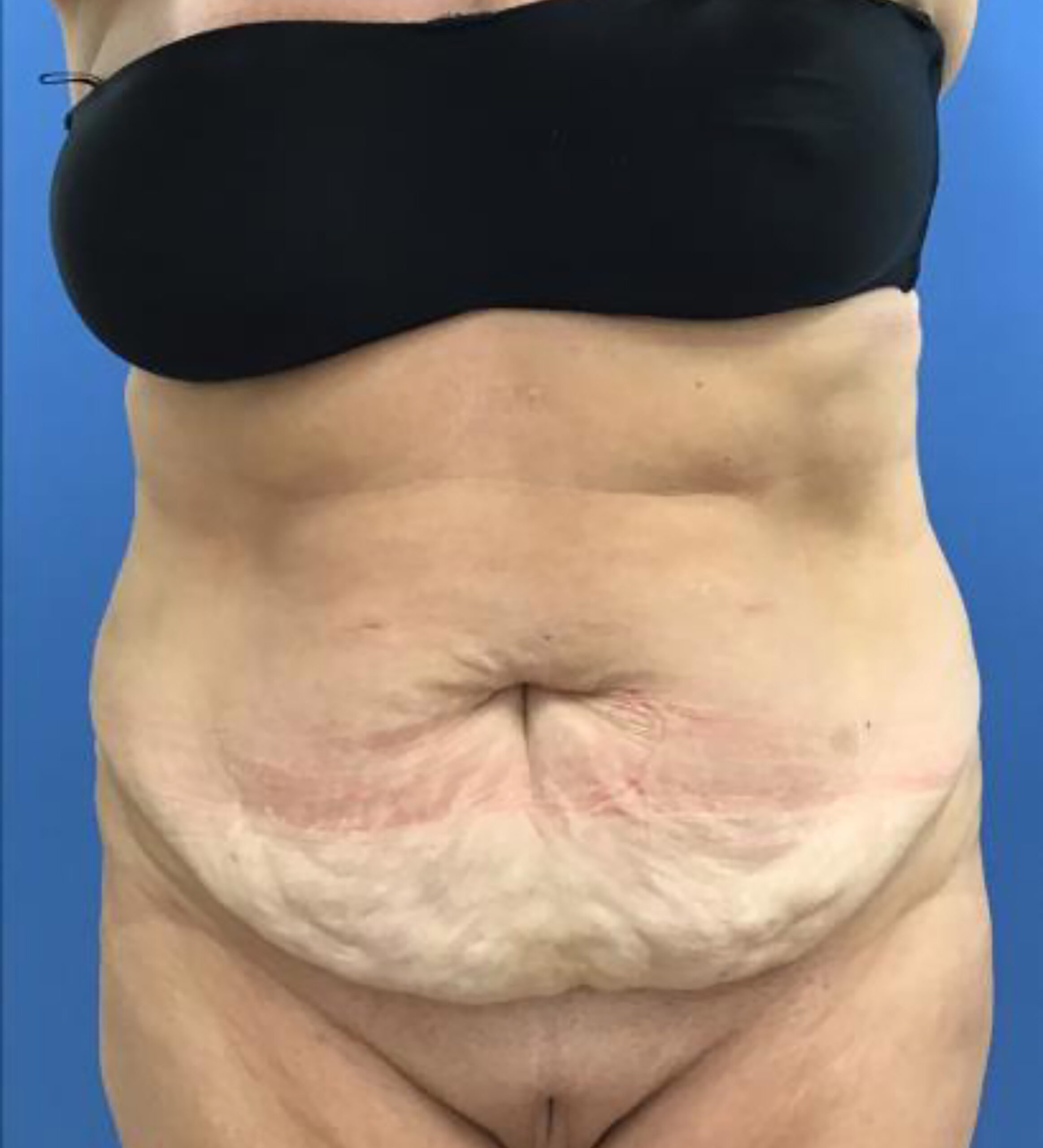 Tummy Tuck – Patient 2 Before