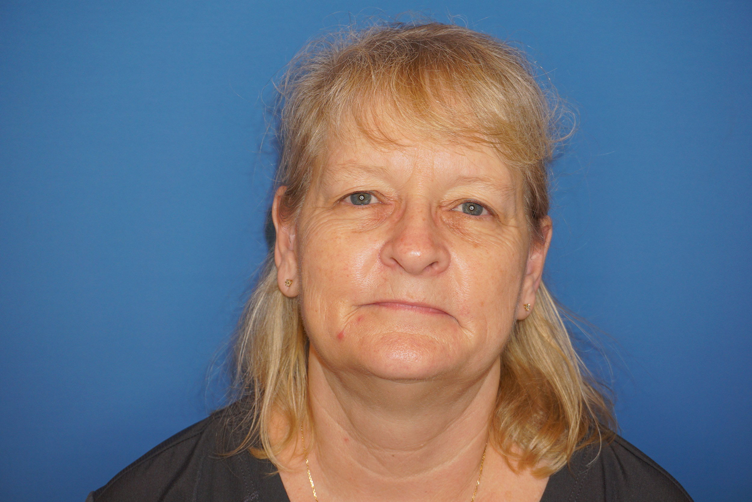 Blepharoplasty – Patient 2 Before