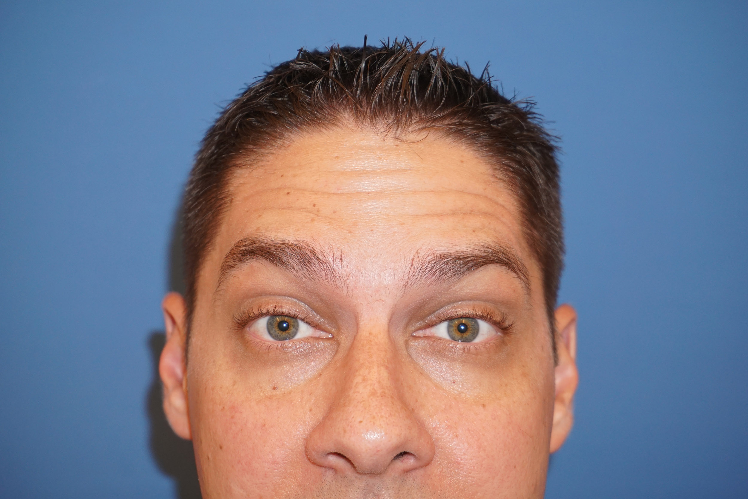 Botox – Patient 2 Before