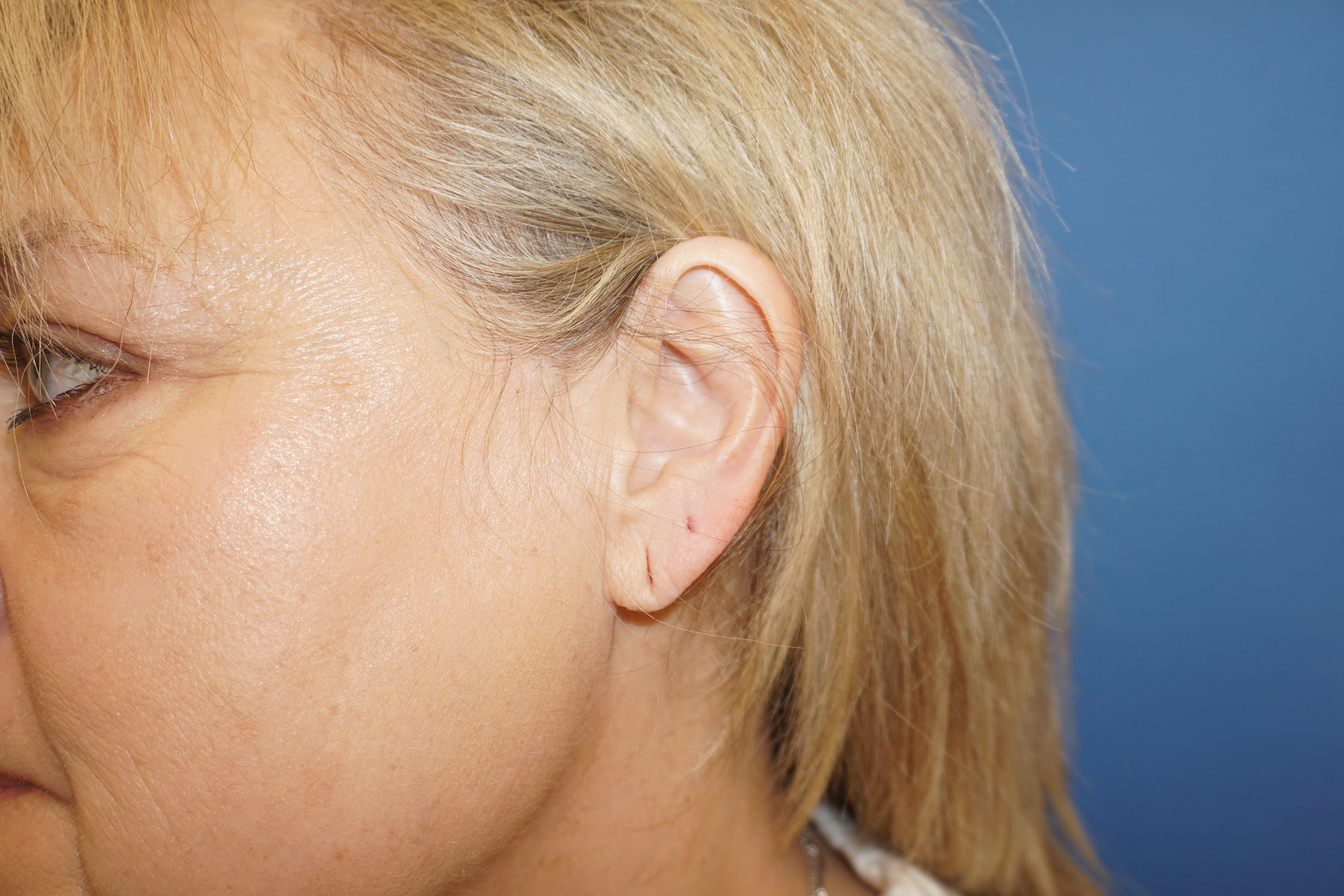 Ear Surgery – Patient 2 Before