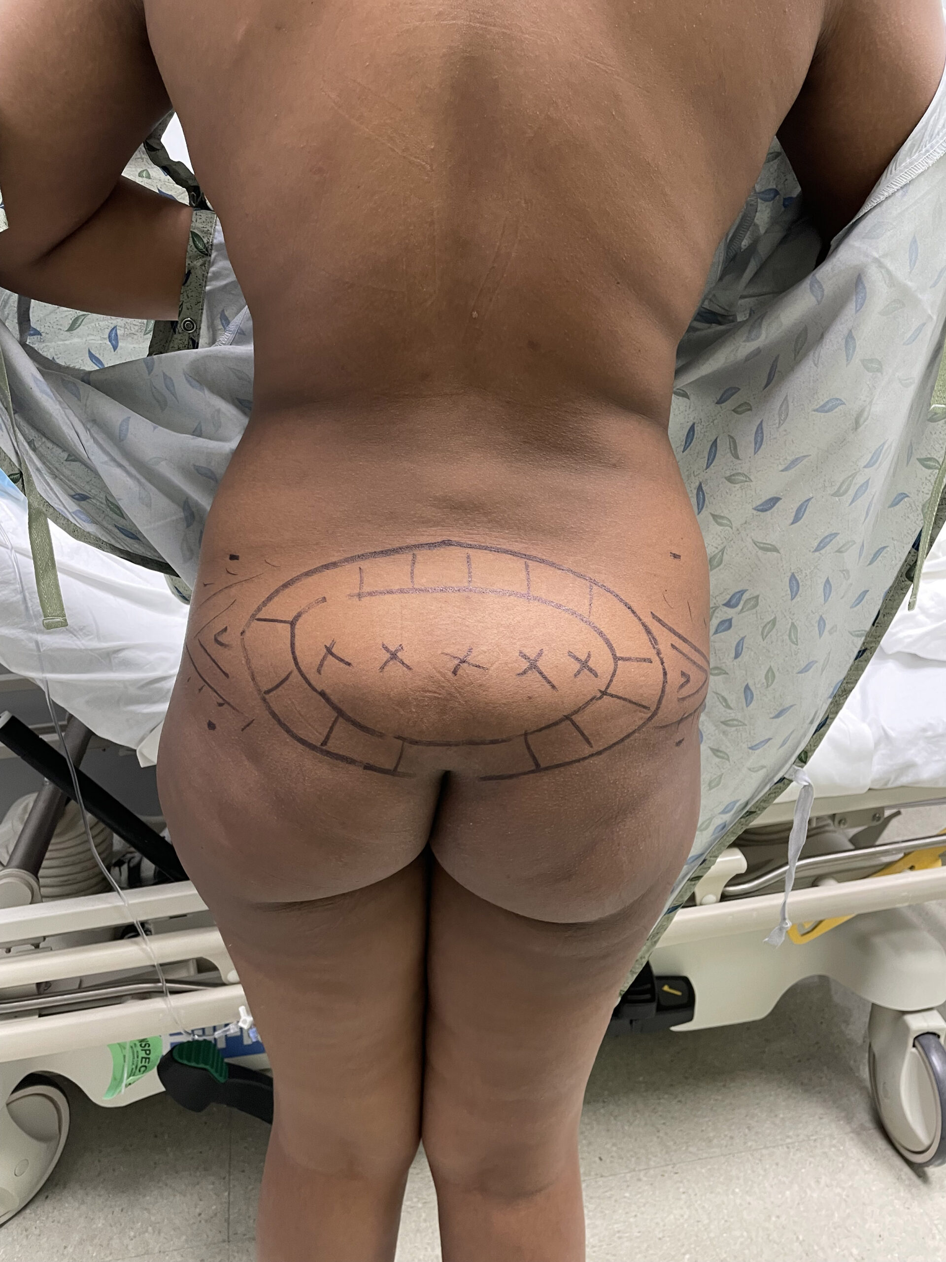Liposuction – Patient 2 Before