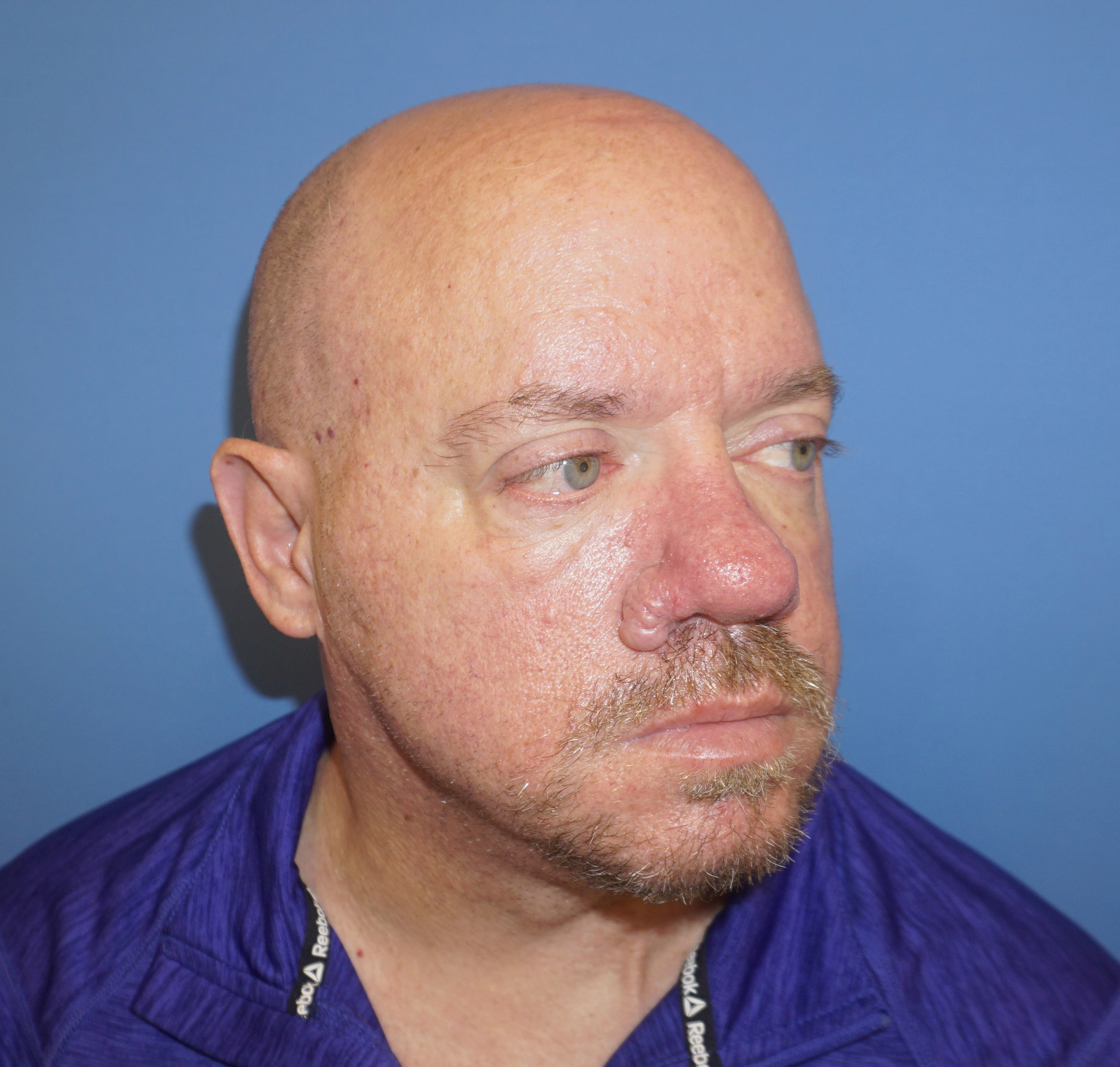 Nose Reshaping Patient 2 Before