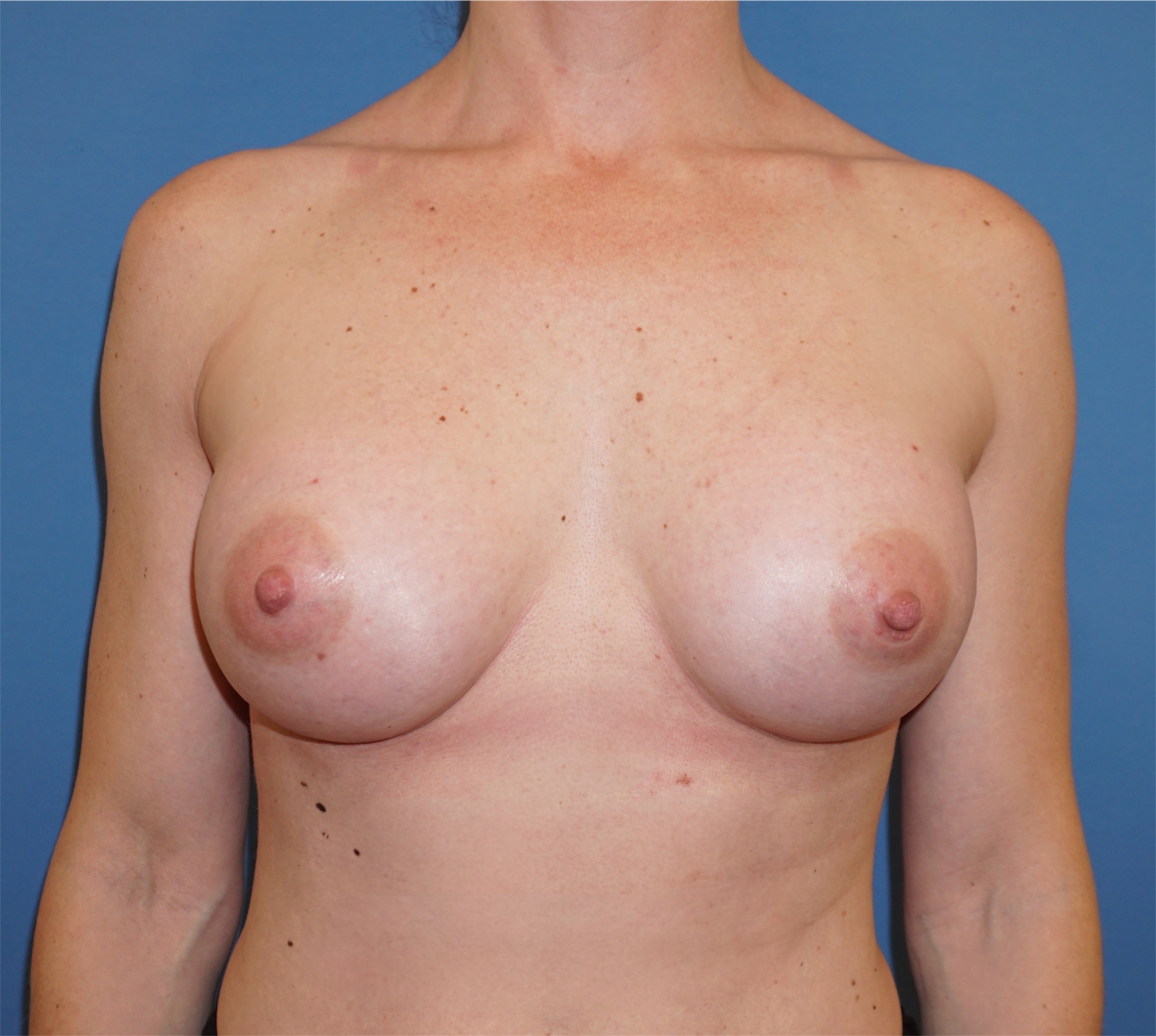 Breast Augmentation – Patient 2 After