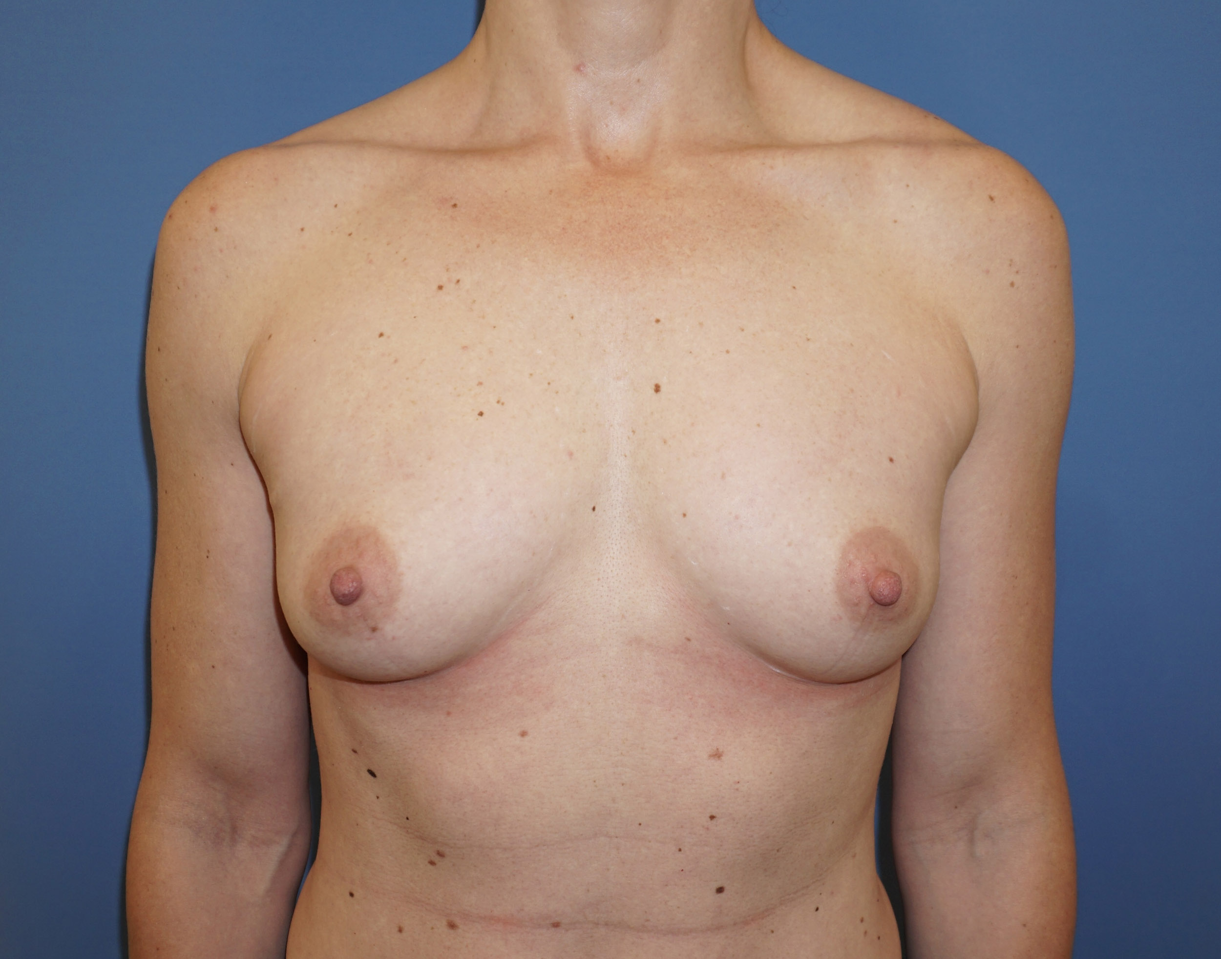 Breast Augmentation – Patient 2 Before