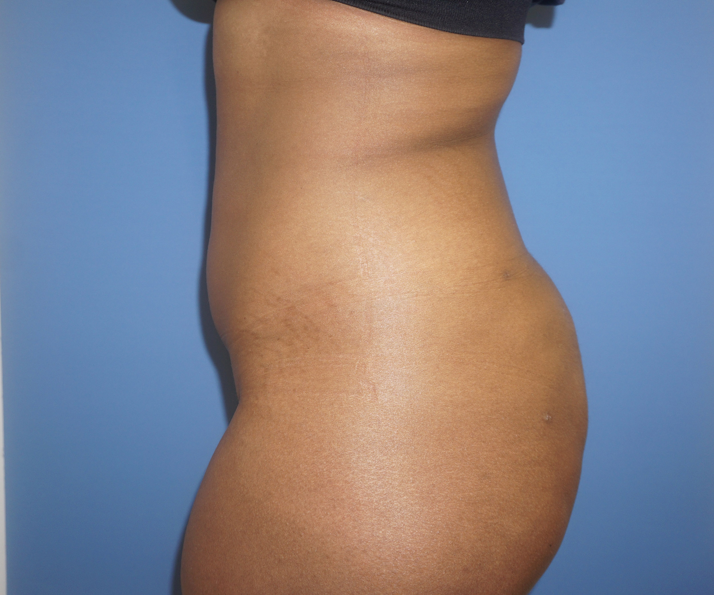 Liposuction – Patient 2 After Side