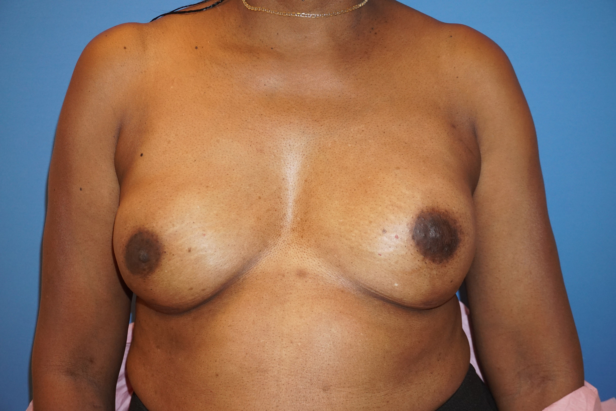 Breast Reconstruction for Cancer – Patient 22 After