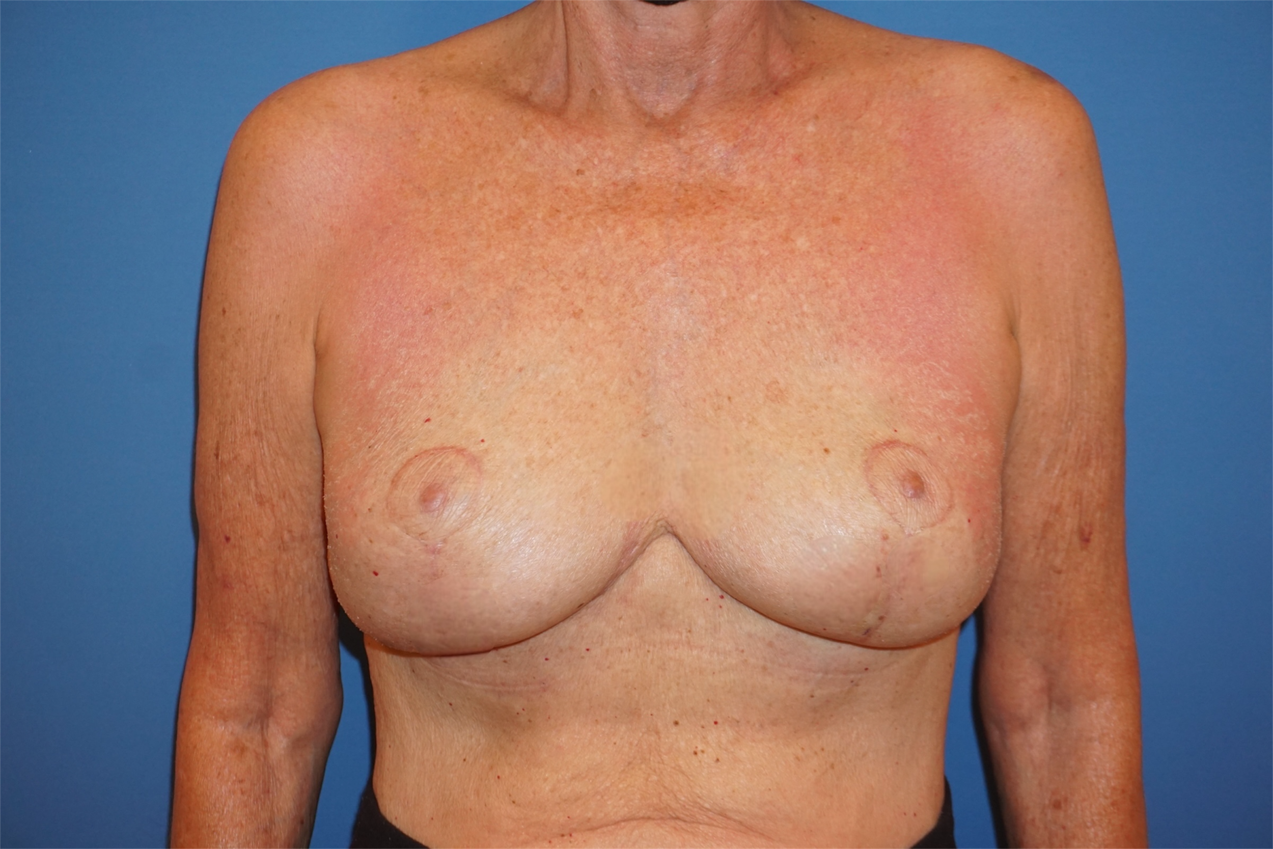 Breast Lift – Patient 22 After