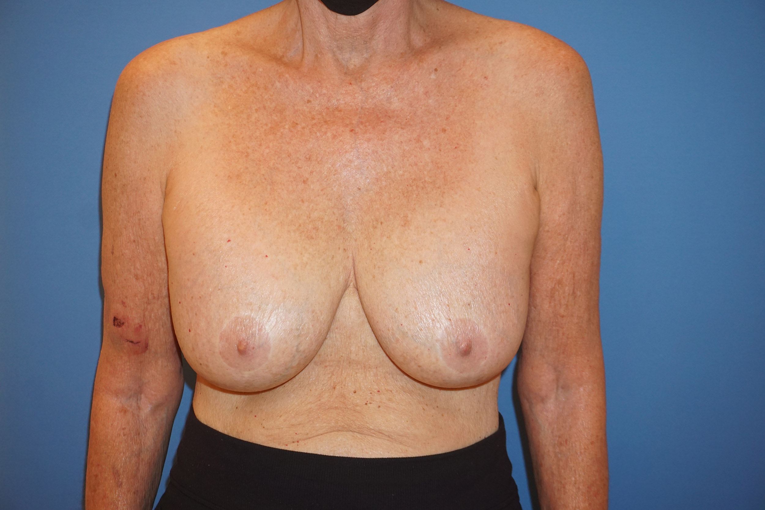 Breast Lift – Patient 22 Before