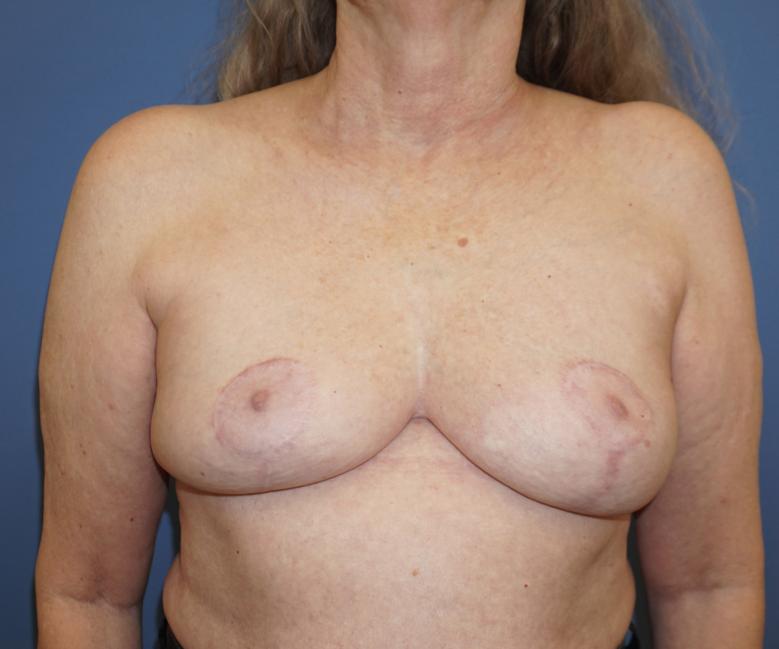 Breast Lift – Patient 23 After