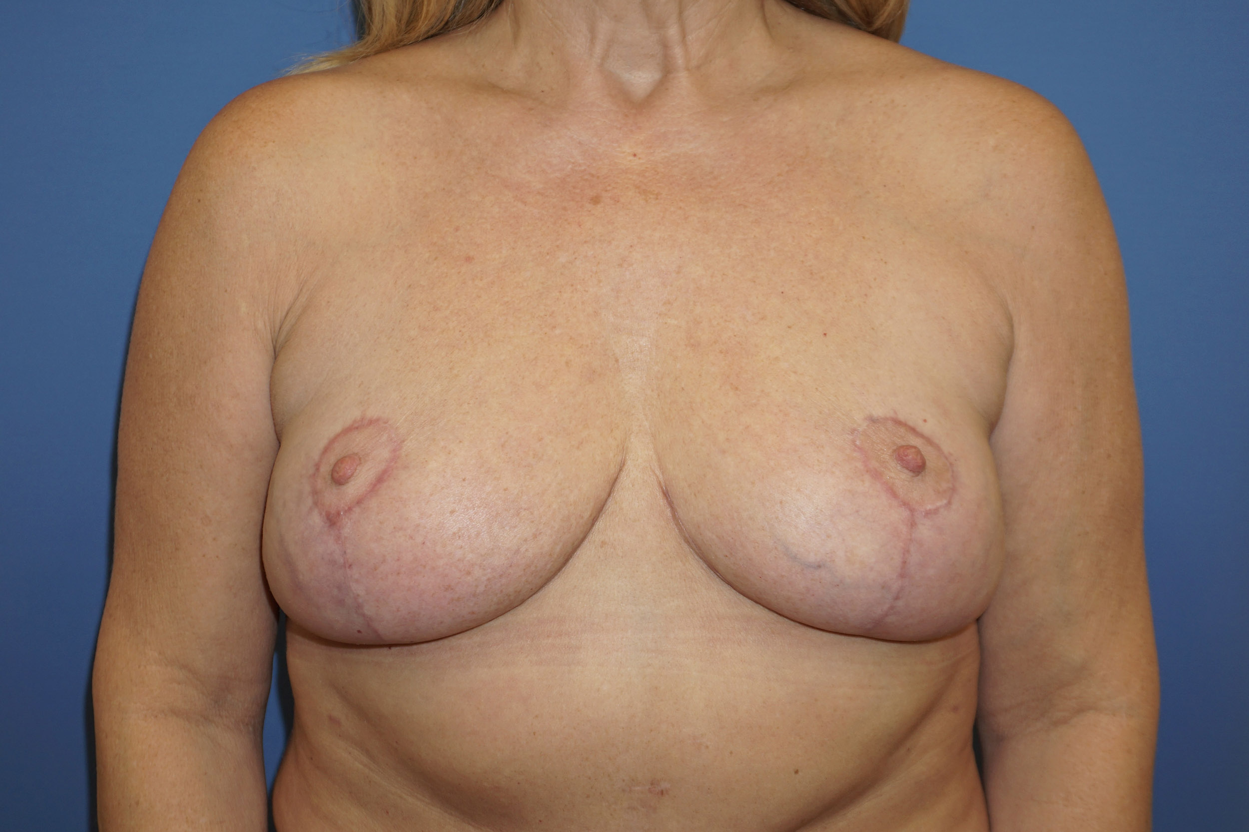 Breast Lift – Patient 24 After