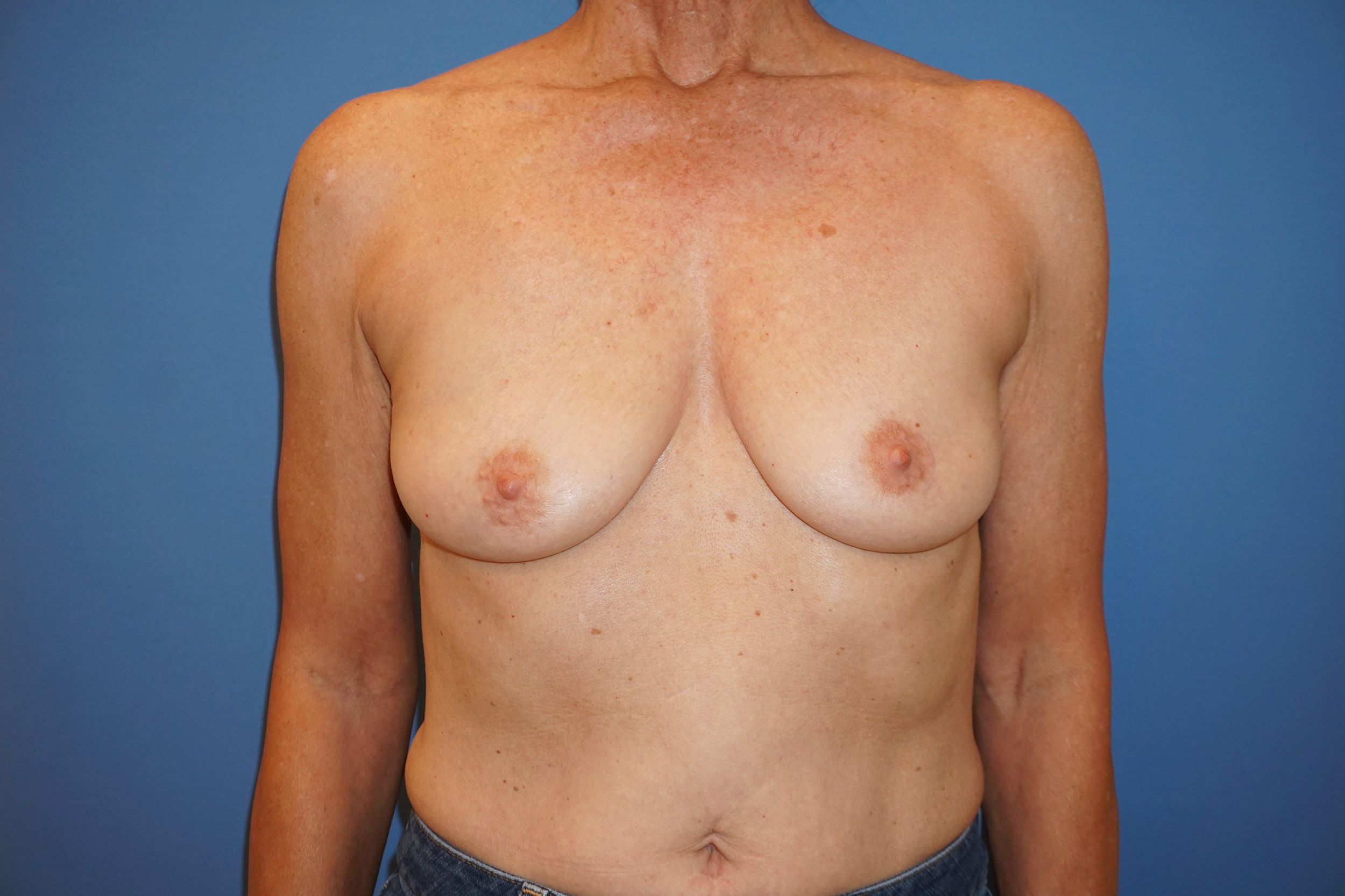 Breast Reconstruction for Cancer – Patient 25 Before