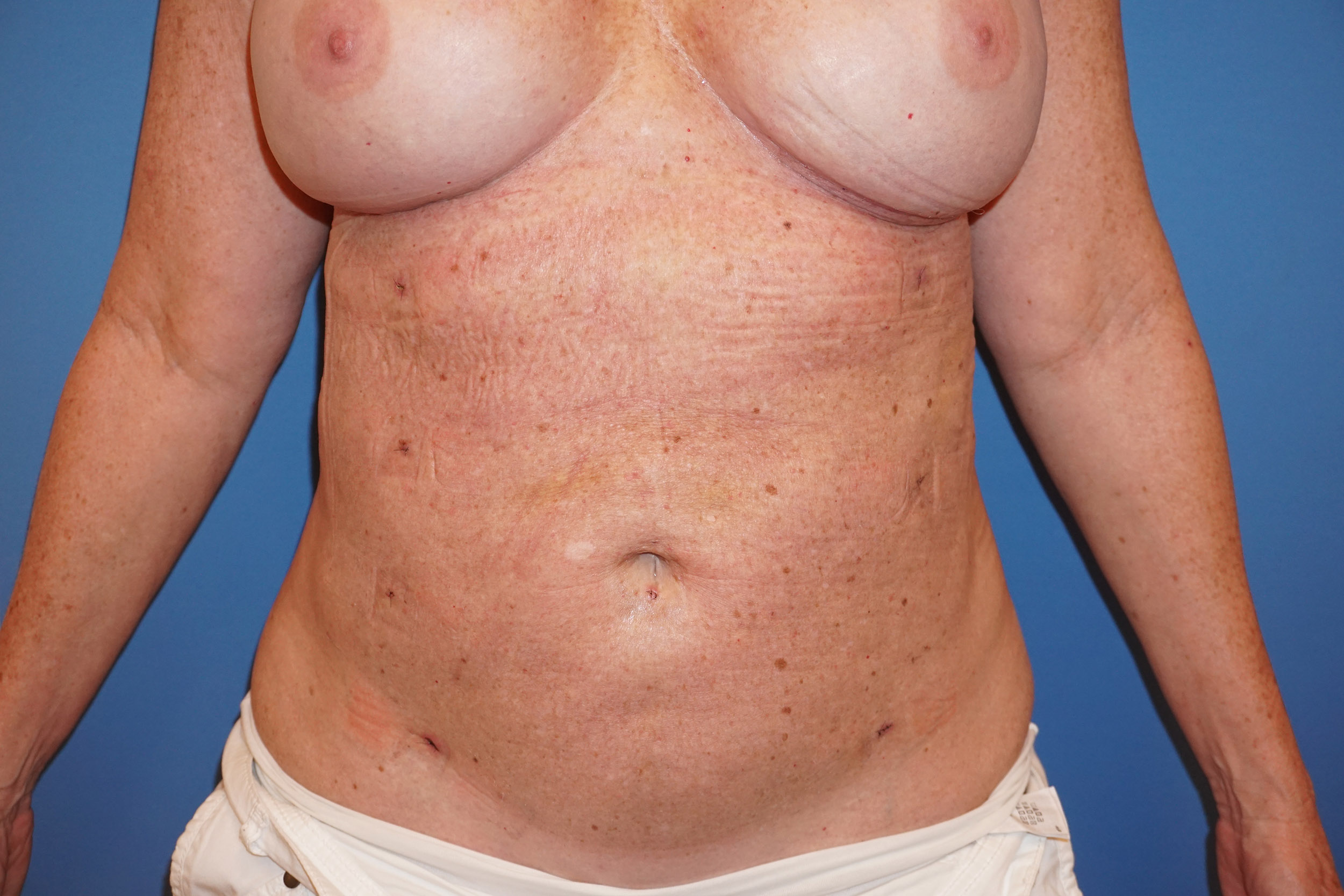 Liposuction – Patient 3 After