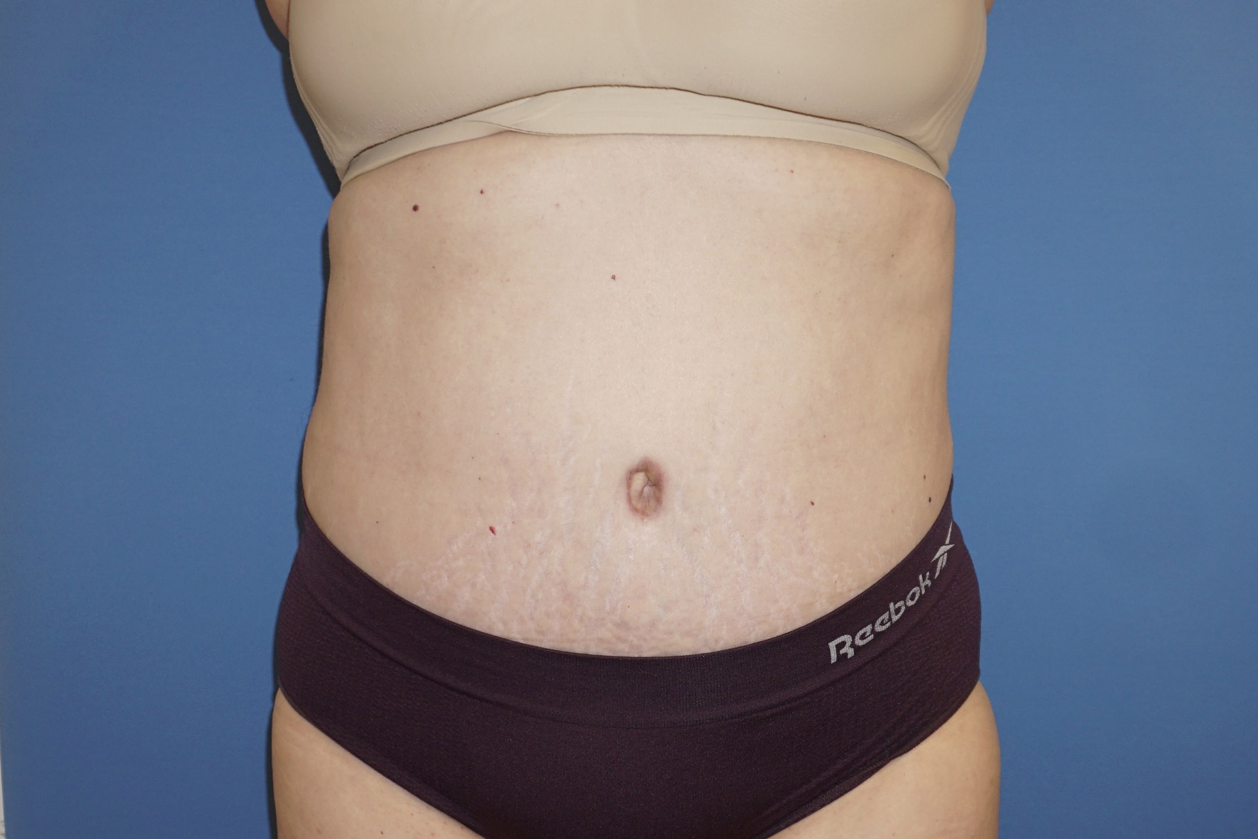 Tummy Tuck – Patient 3 After