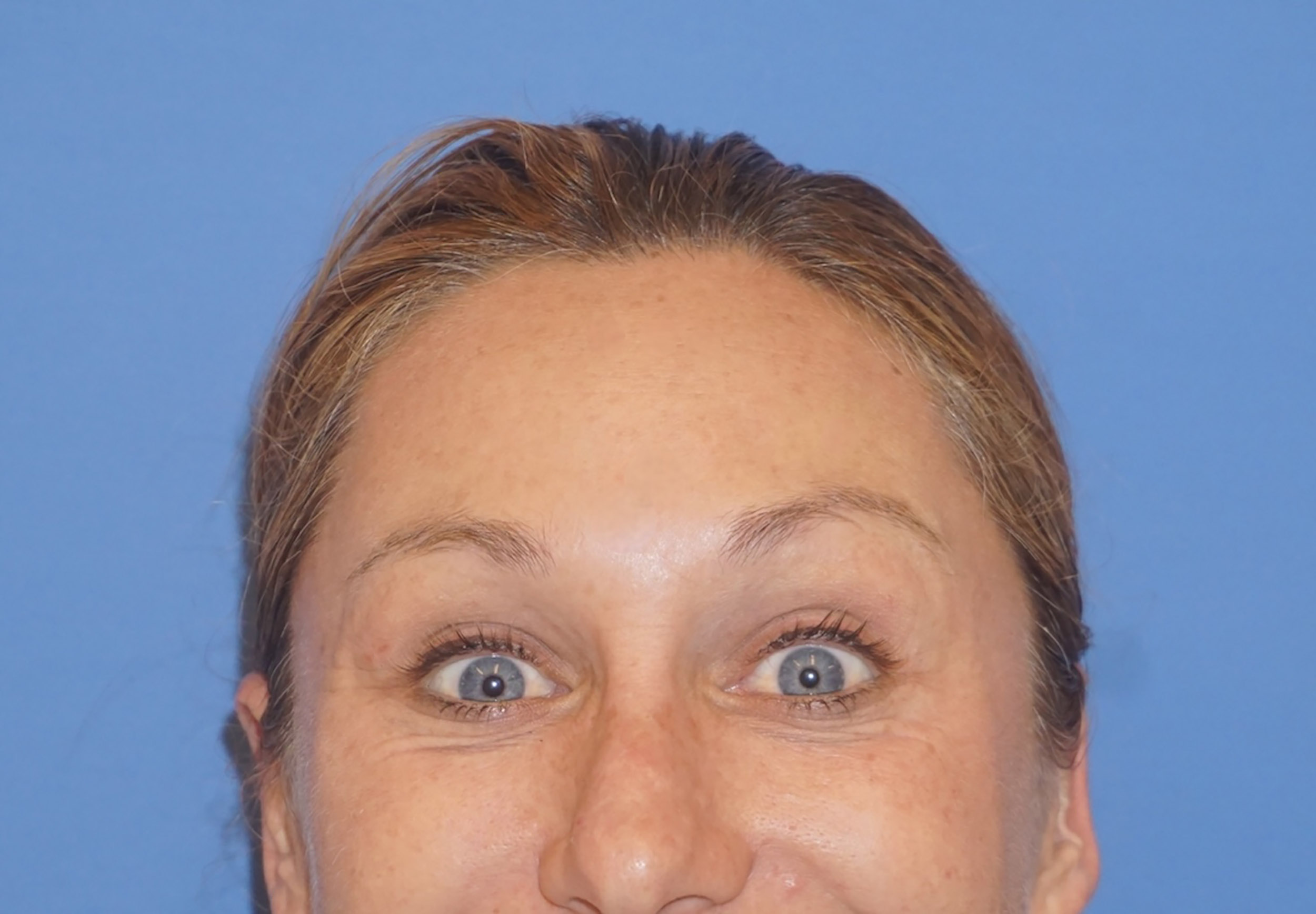 Botox – Patient 3 After