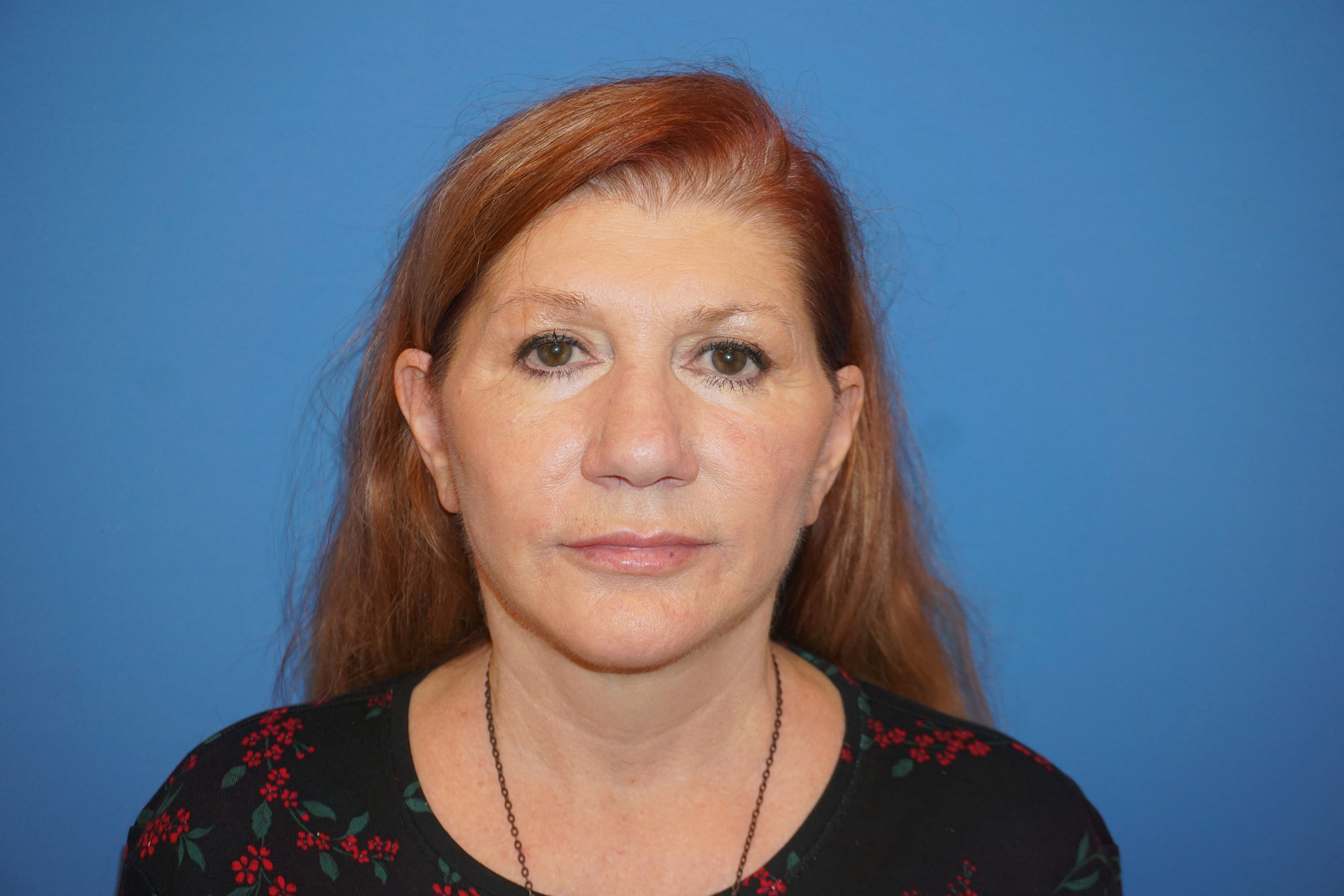 Blepharoplasty – Patient 3 After