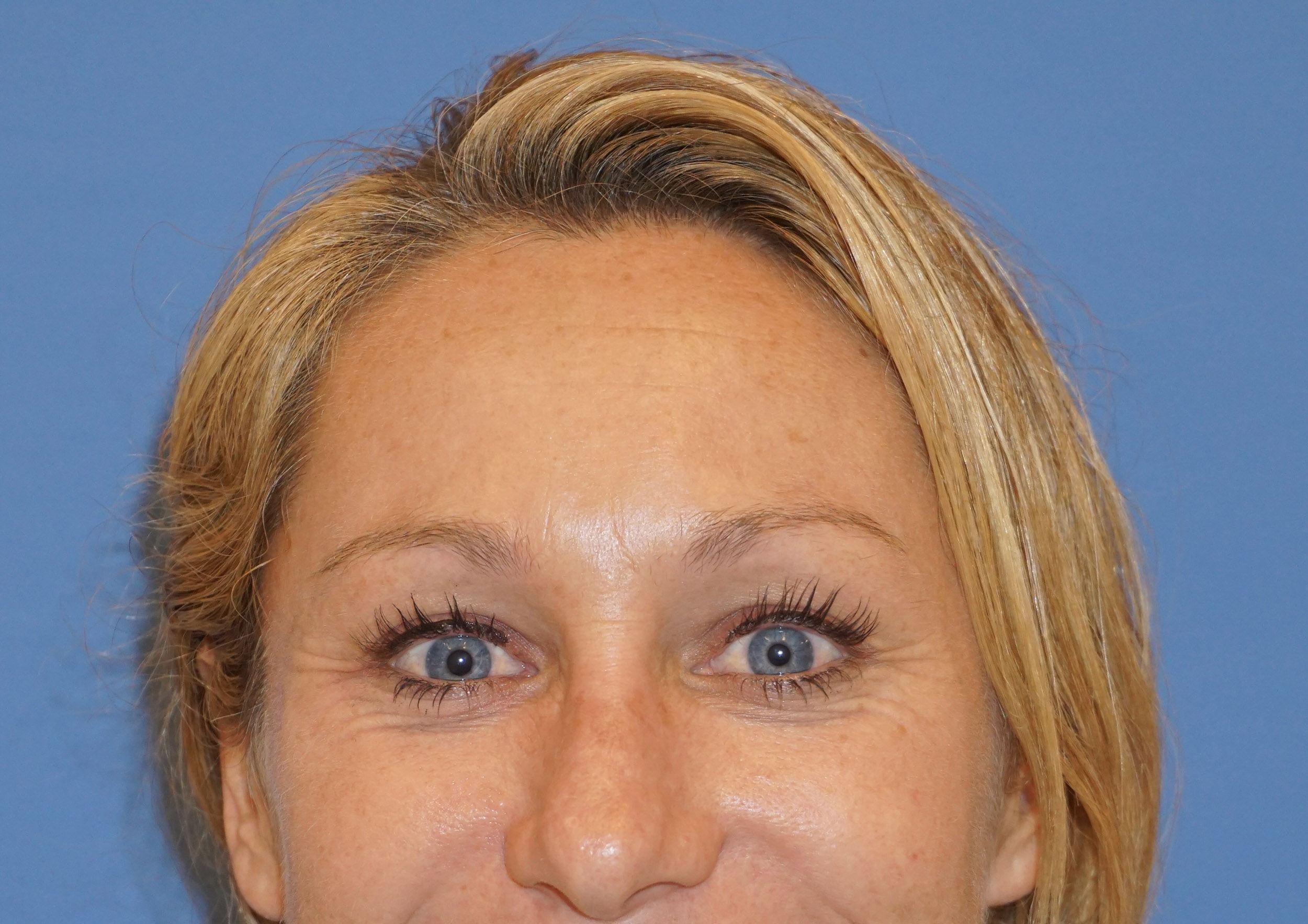 Botox – Patient 3 Before