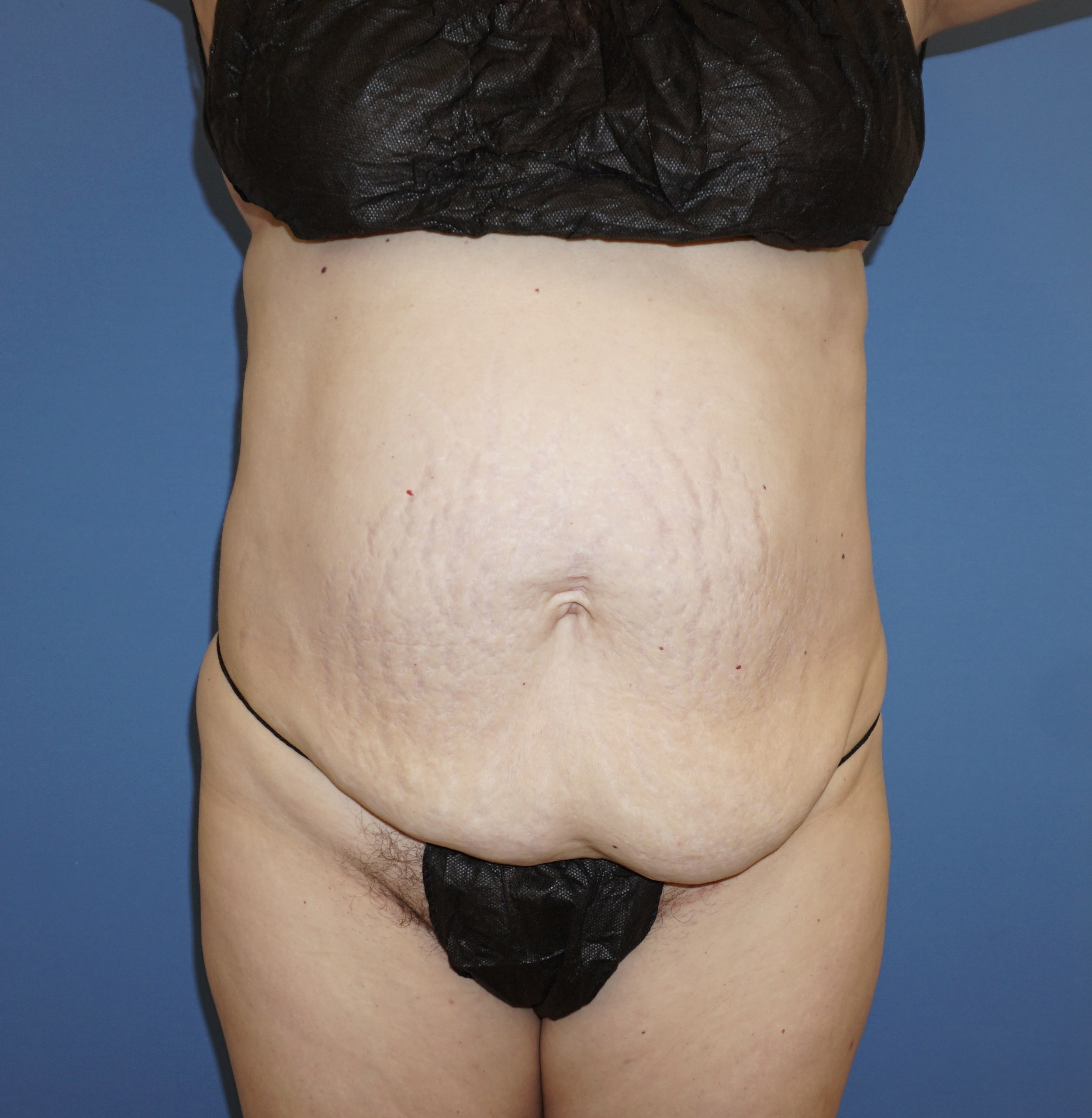 Tummy Tuck – Patient 3 Before
