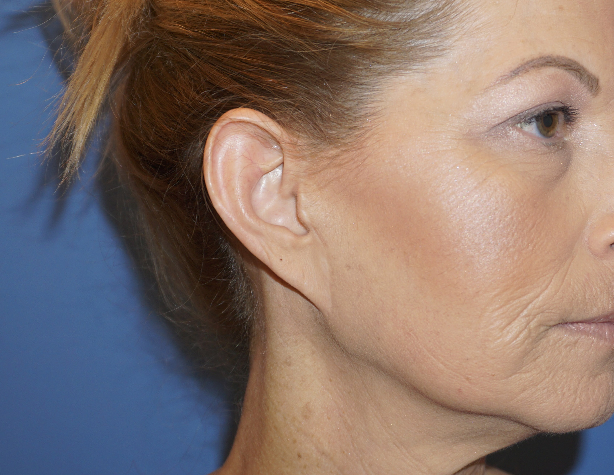 Ear Surgery – Patient 3 Before