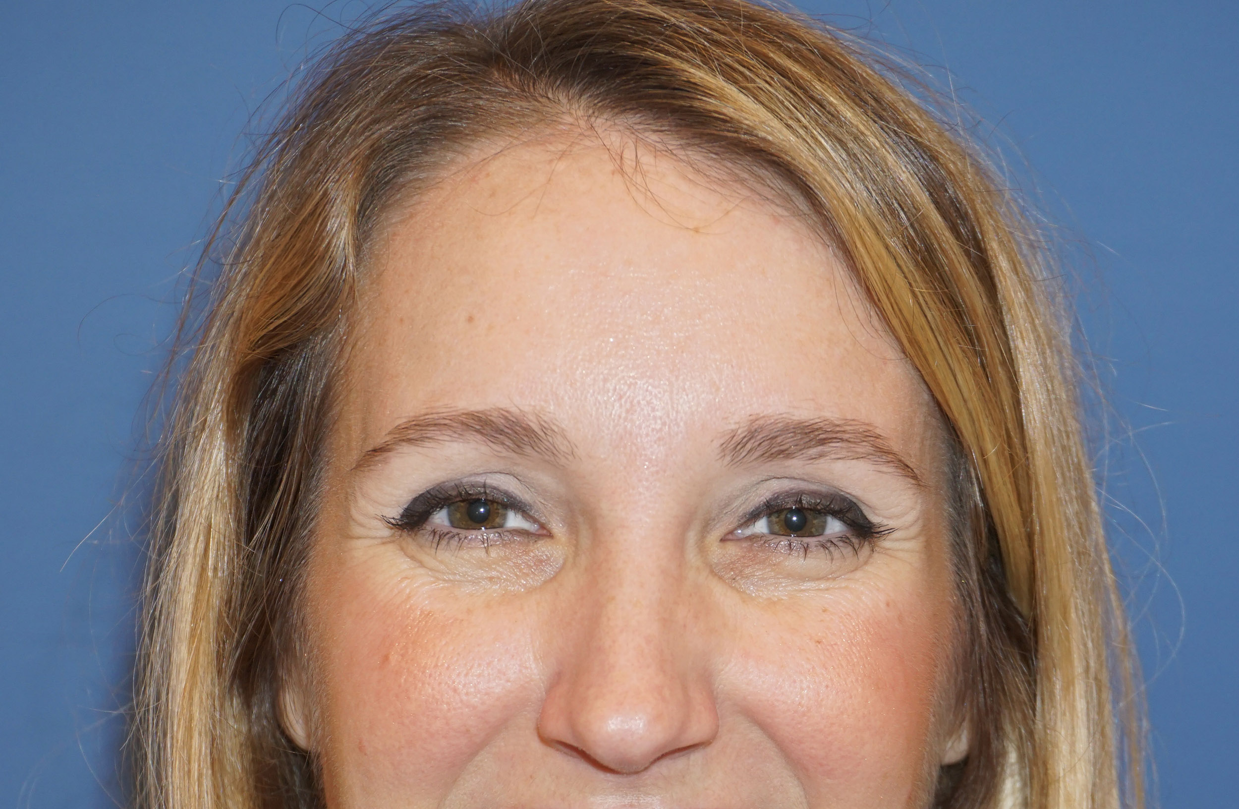 Botox – Patient 4 After