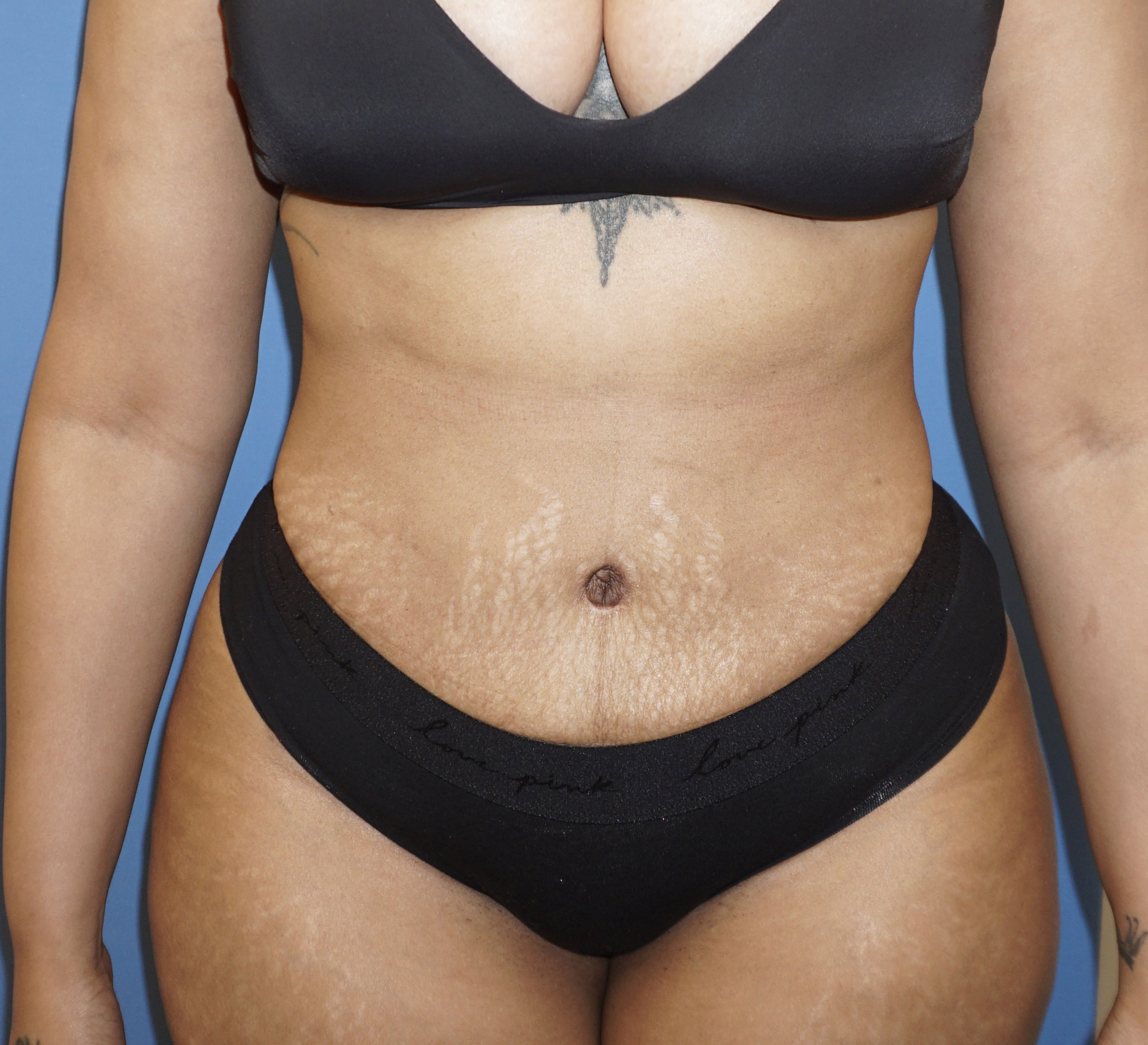 Tummy Tuck – Patient 4 After