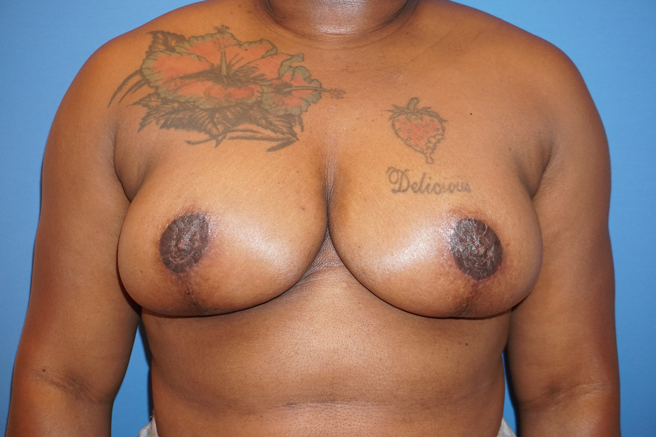 Breast Lift – Patient 4 After