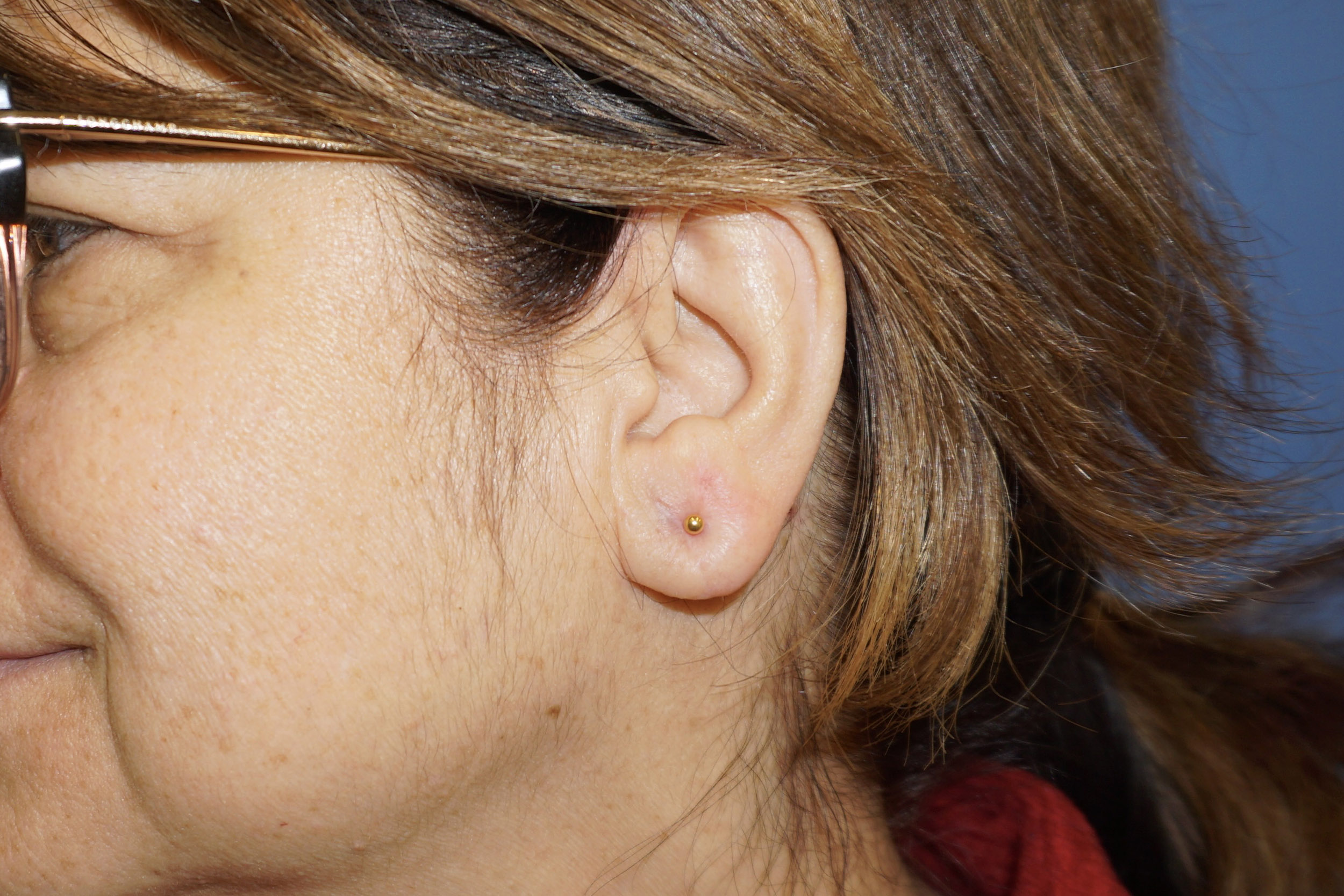 Ear Surgery – Patient 4 After