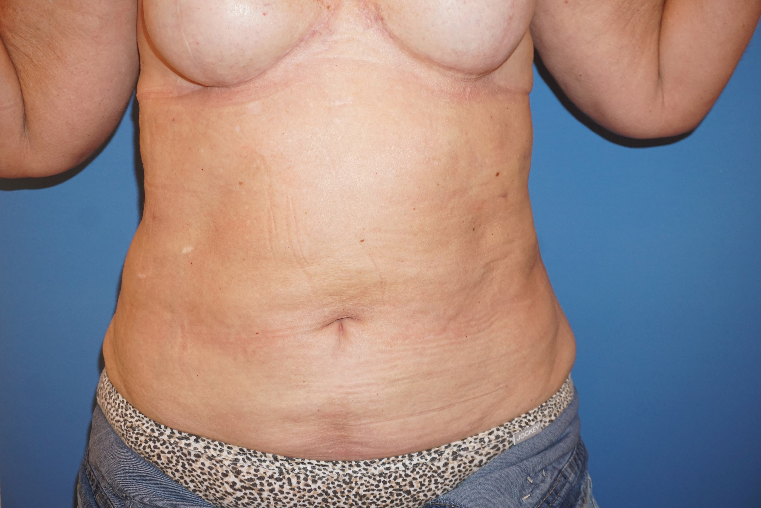 Liposuction – Patient 4 After
