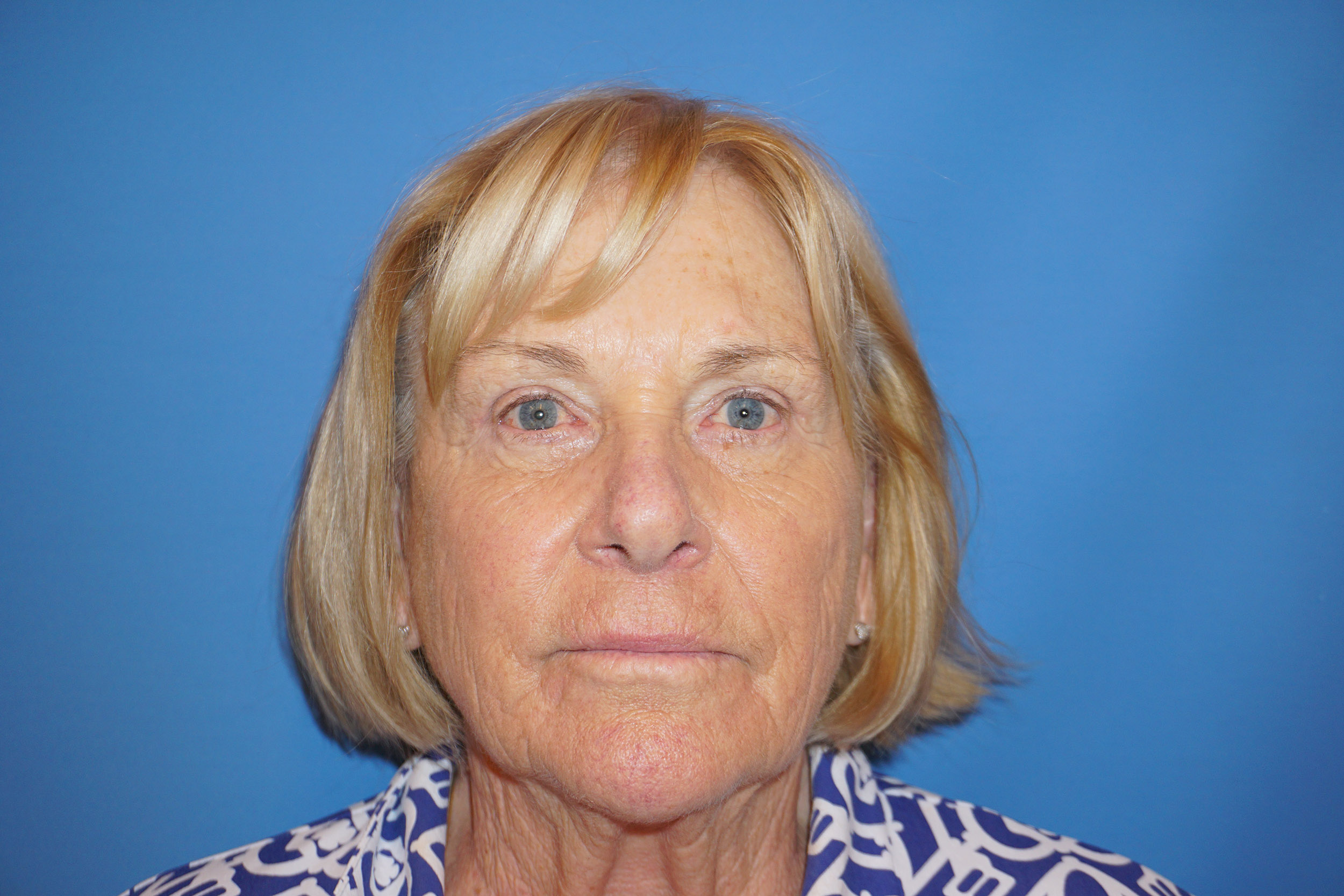 Blepharoplasty – Patient 4 After