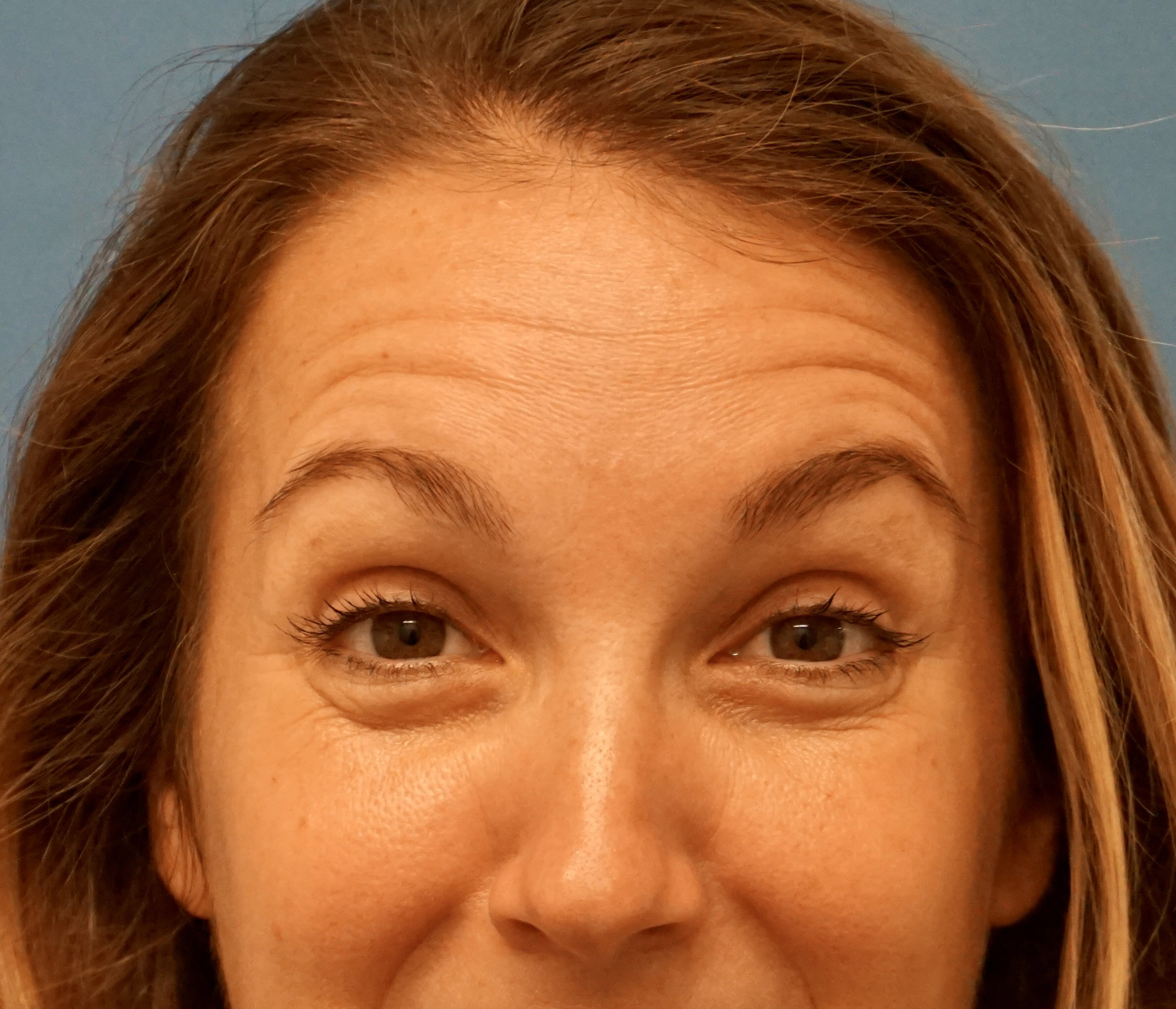 Botox – Patient 4 Before